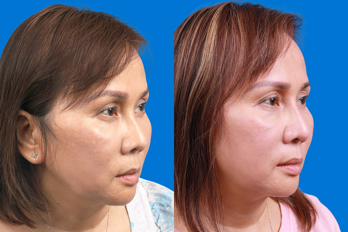 Rhinoplasty Before & After Gallery - Patient 227546 - Image 2