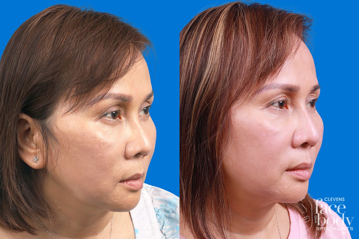 Rhinoplasty Before & After Gallery - Patient 227546 - Image 2