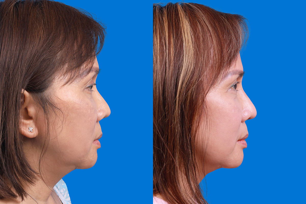 Rhinoplasty Before & After Gallery - Patient 227546 - Image 3