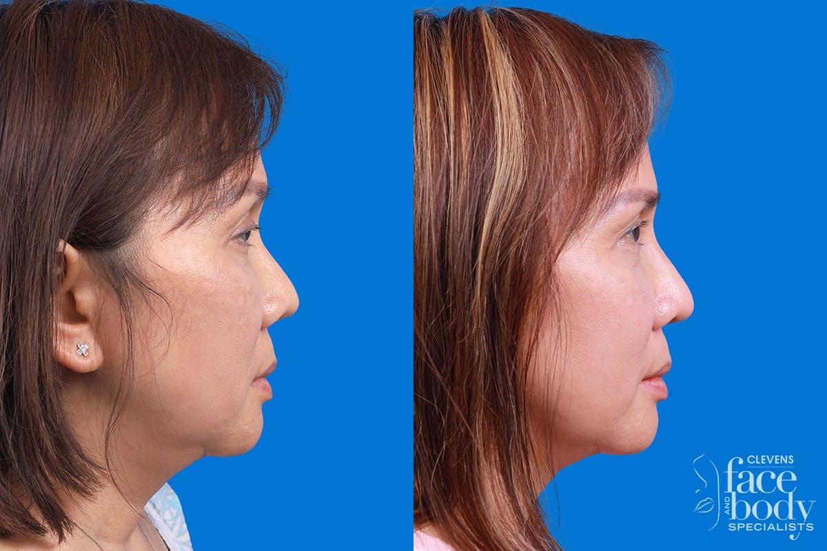 Rhinoplasty Before & After Gallery - Patient 227546 - Image 3