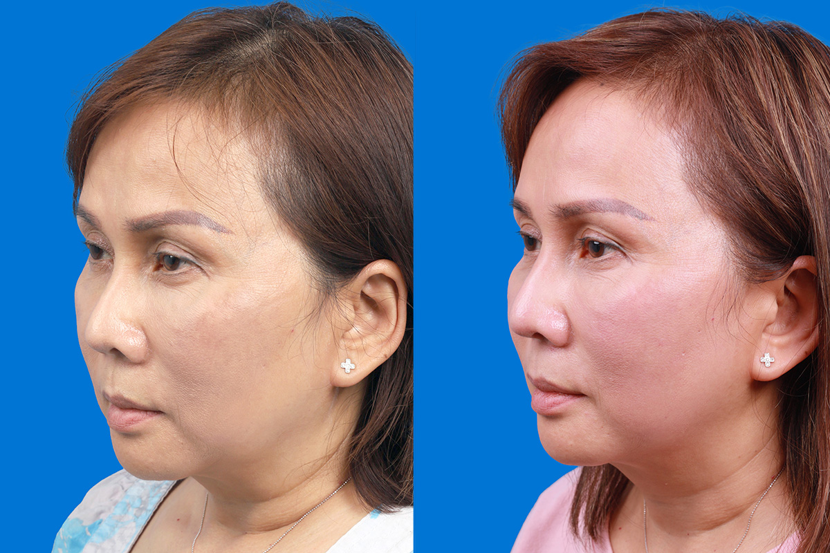 Rhinoplasty Before & After Gallery - Patient 227546 - Image 4
