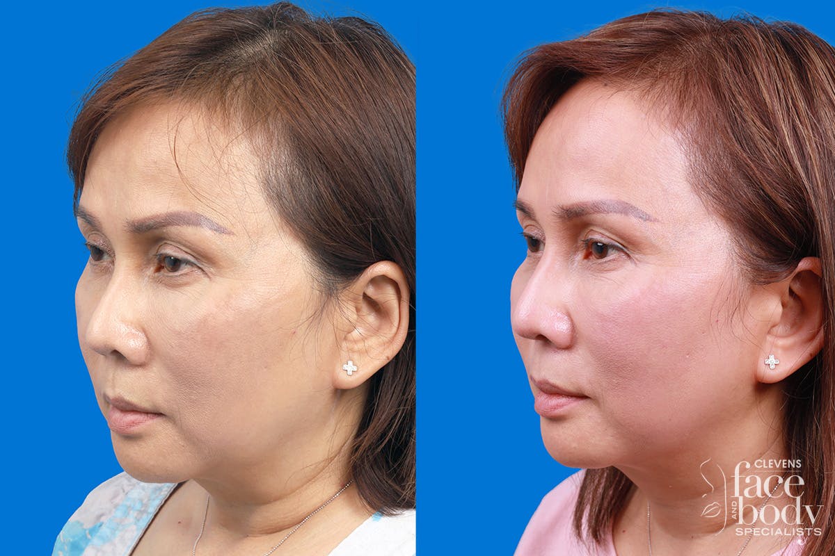 Rhinoplasty Before & After Gallery - Patient 227546 - Image 4