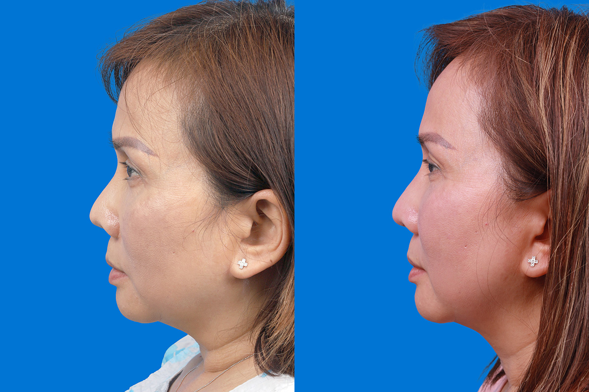 Rhinoplasty Before & After Gallery - Patient 227546 - Image 5