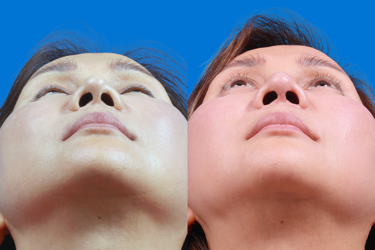 Rhinoplasty Before & After Gallery - Patient 227546 - Image 6