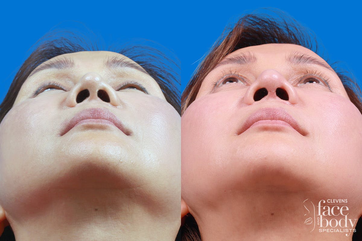 Rhinoplasty Before & After Gallery - Patient 227546 - Image 6