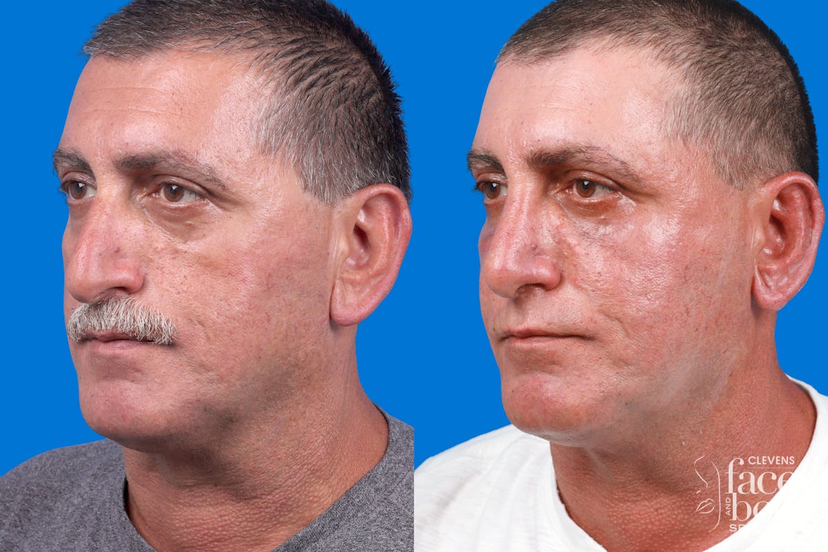 Rhinoplasty Before & After Gallery - Patient 122593918 - Image 2