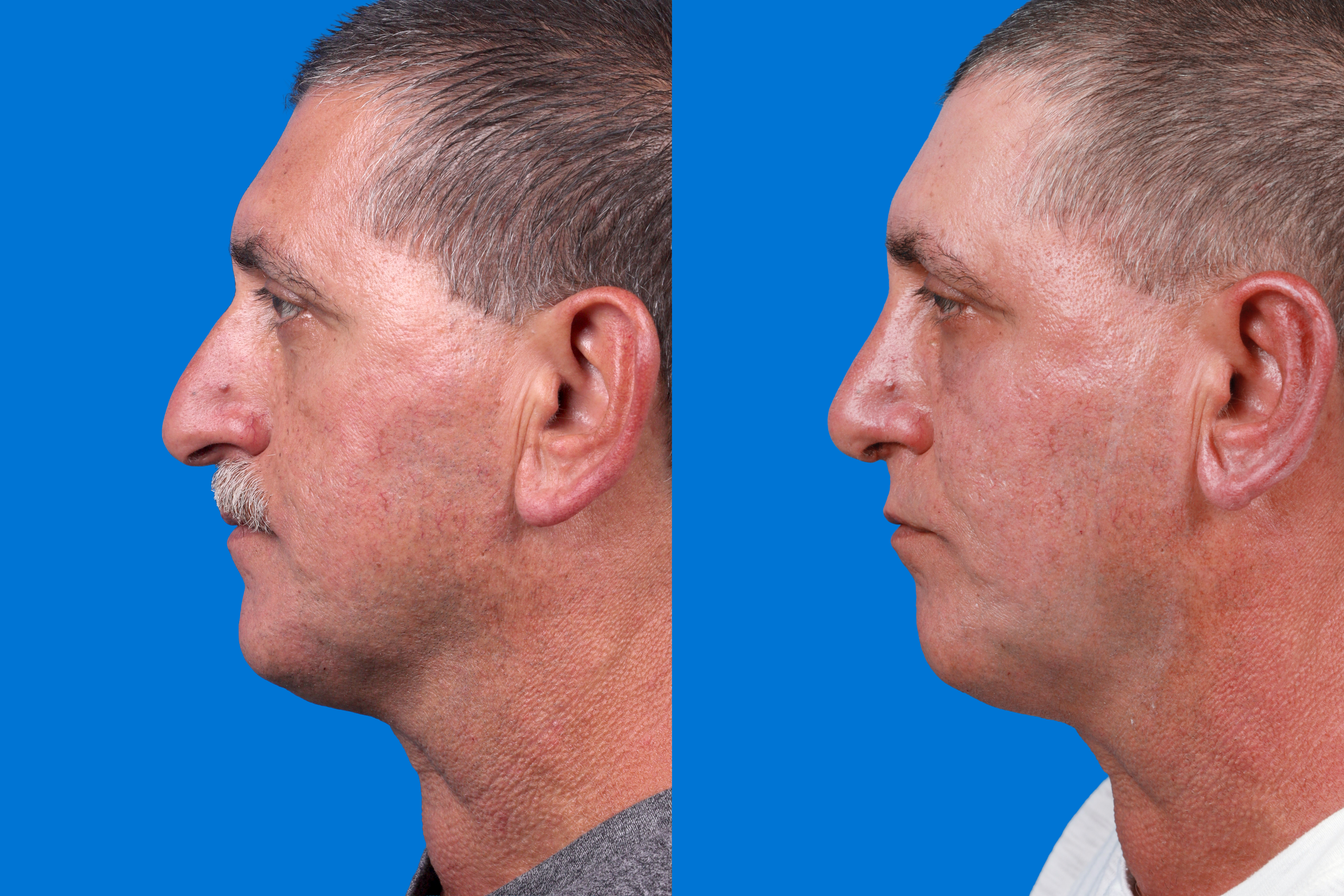 Ear Surgery Before & After Gallery - Patient 211435 - Image 5