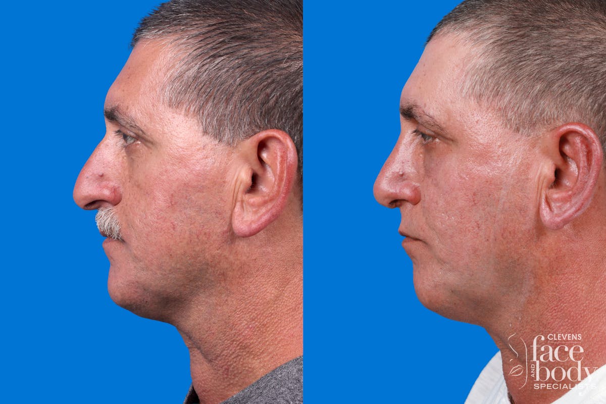 Rhinoplasty Before & After Gallery - Patient 122593918 - Image 1