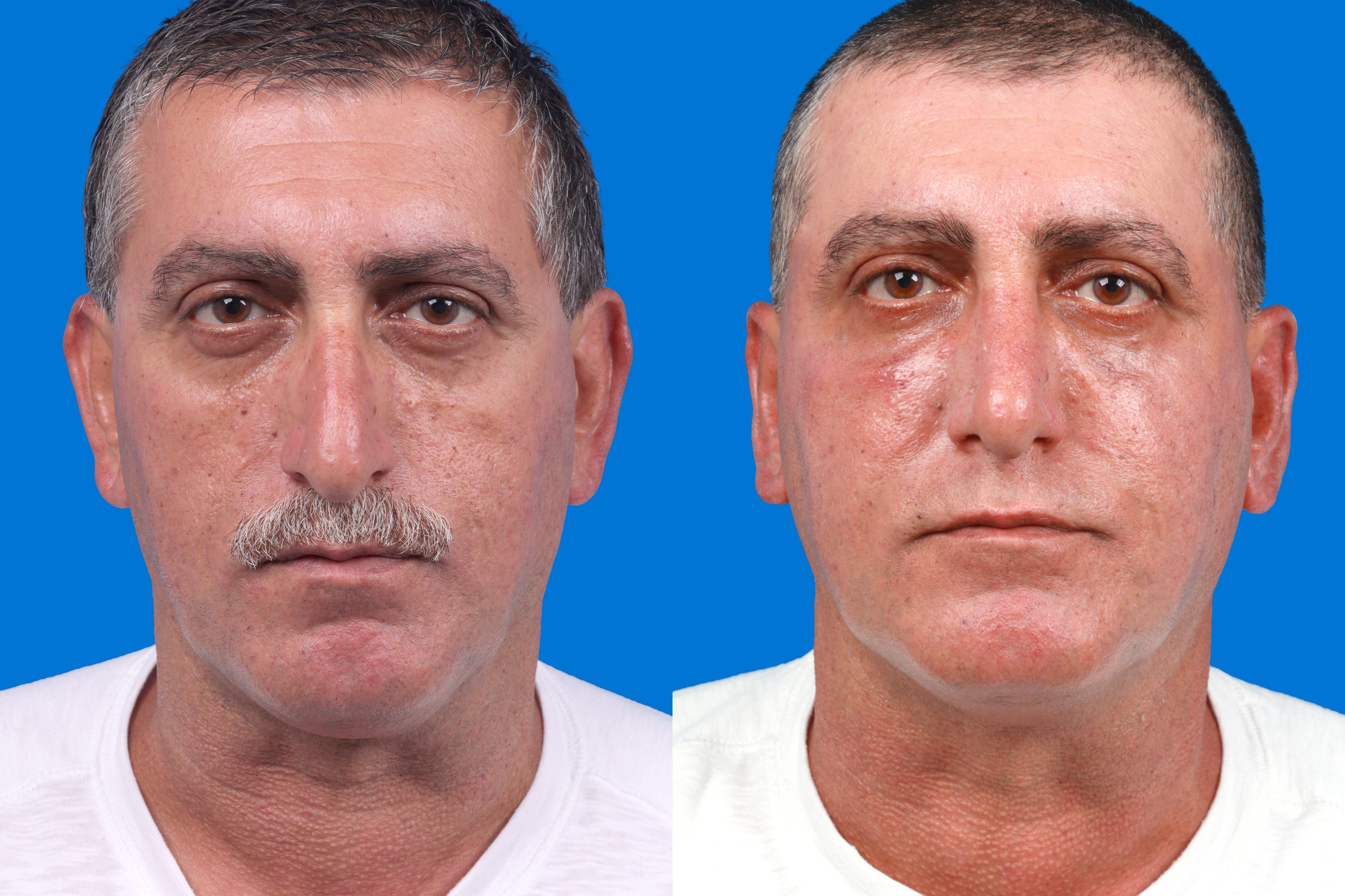 Ear Surgery Before & After Gallery - Patient 211435 - Image 1