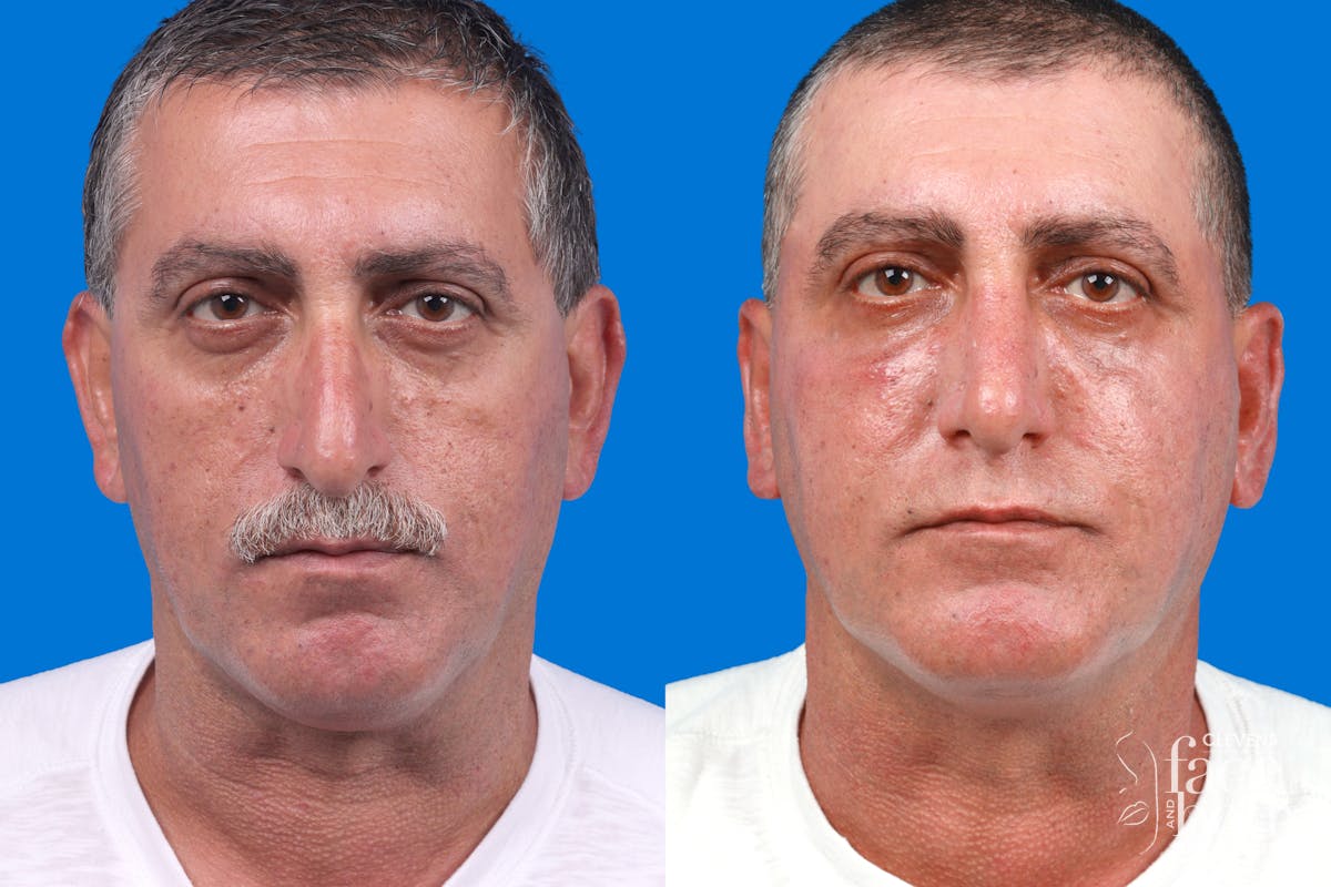 Rhinoplasty Before & After Gallery - Patient 122593918 - Image 3