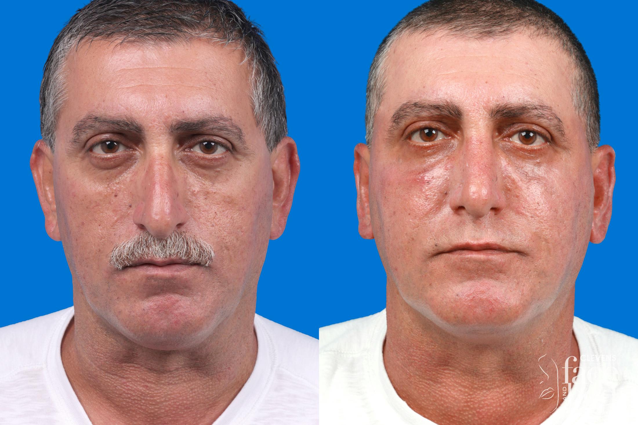 Rhinoplasty Before & After Gallery - Patient 122593918 - Image 3