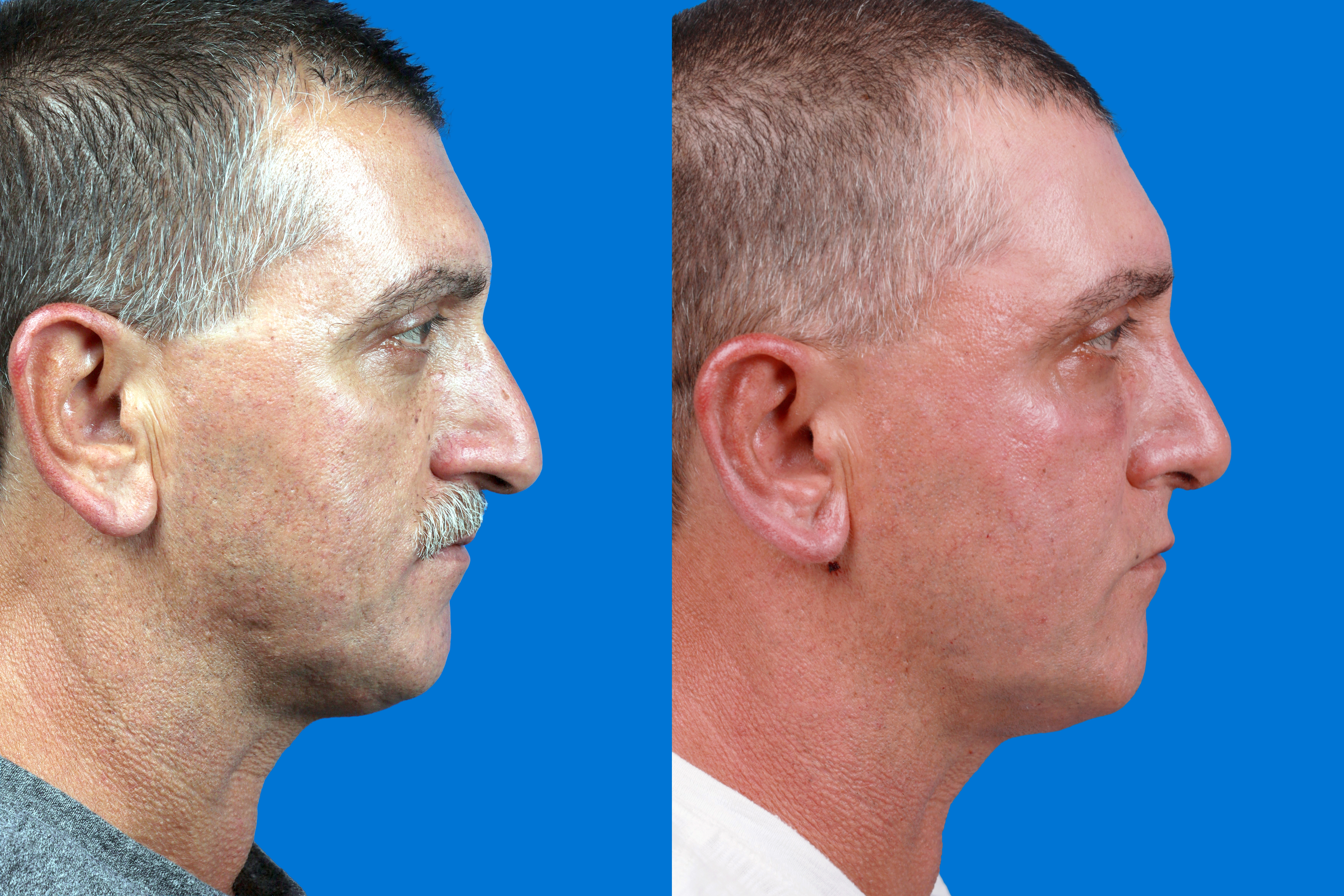 Ear Surgery Before & After Gallery - Patient 211435 - Image 3