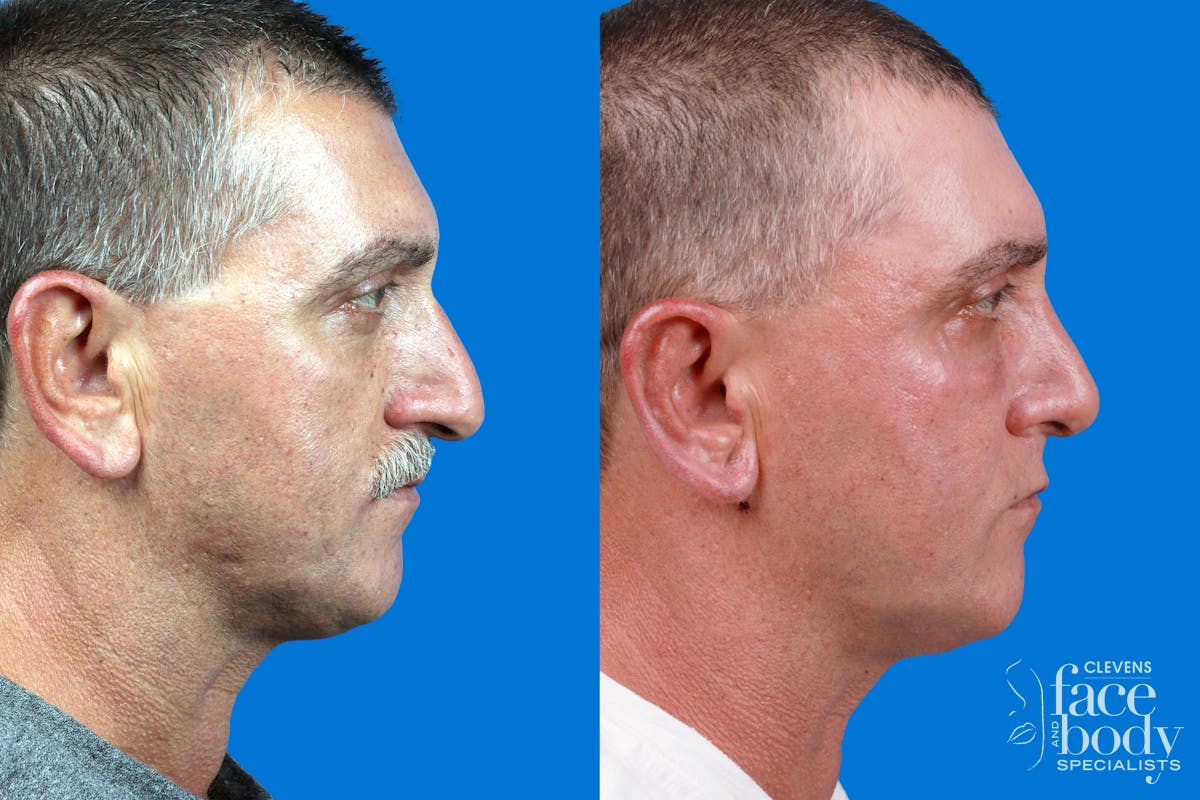 Rhinoplasty Before & After Gallery - Patient 122593918 - Image 5