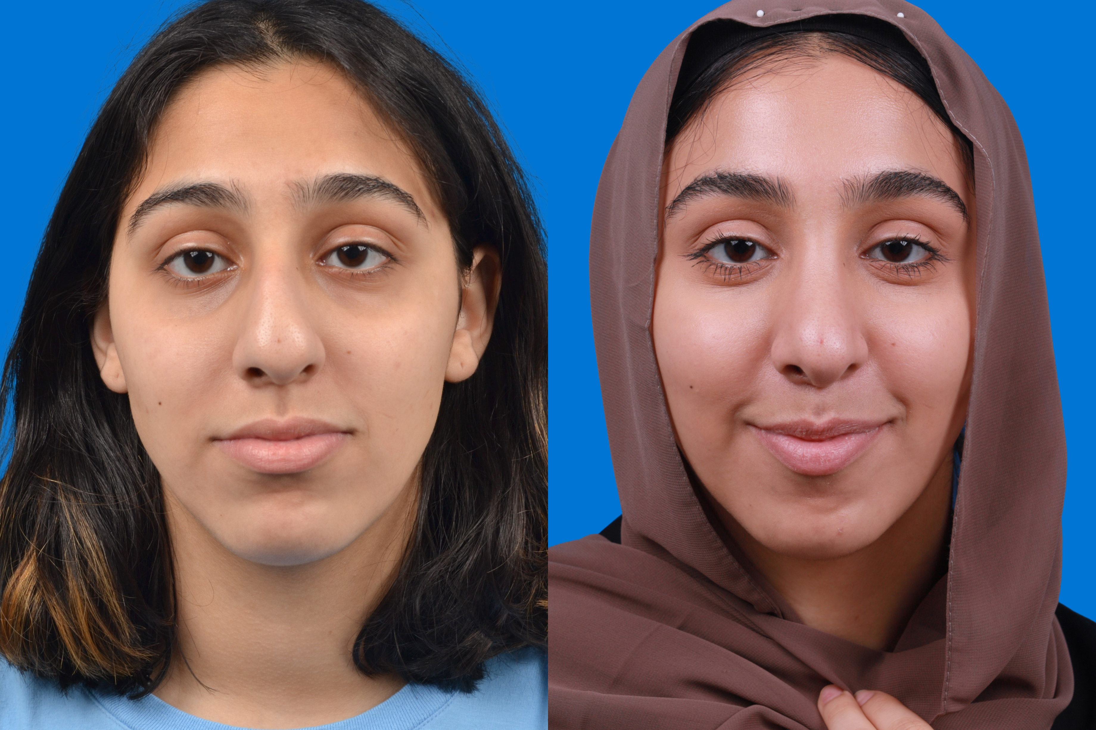 Rhinoplasty Before & After Gallery - Patient 122593916 - Image 3
