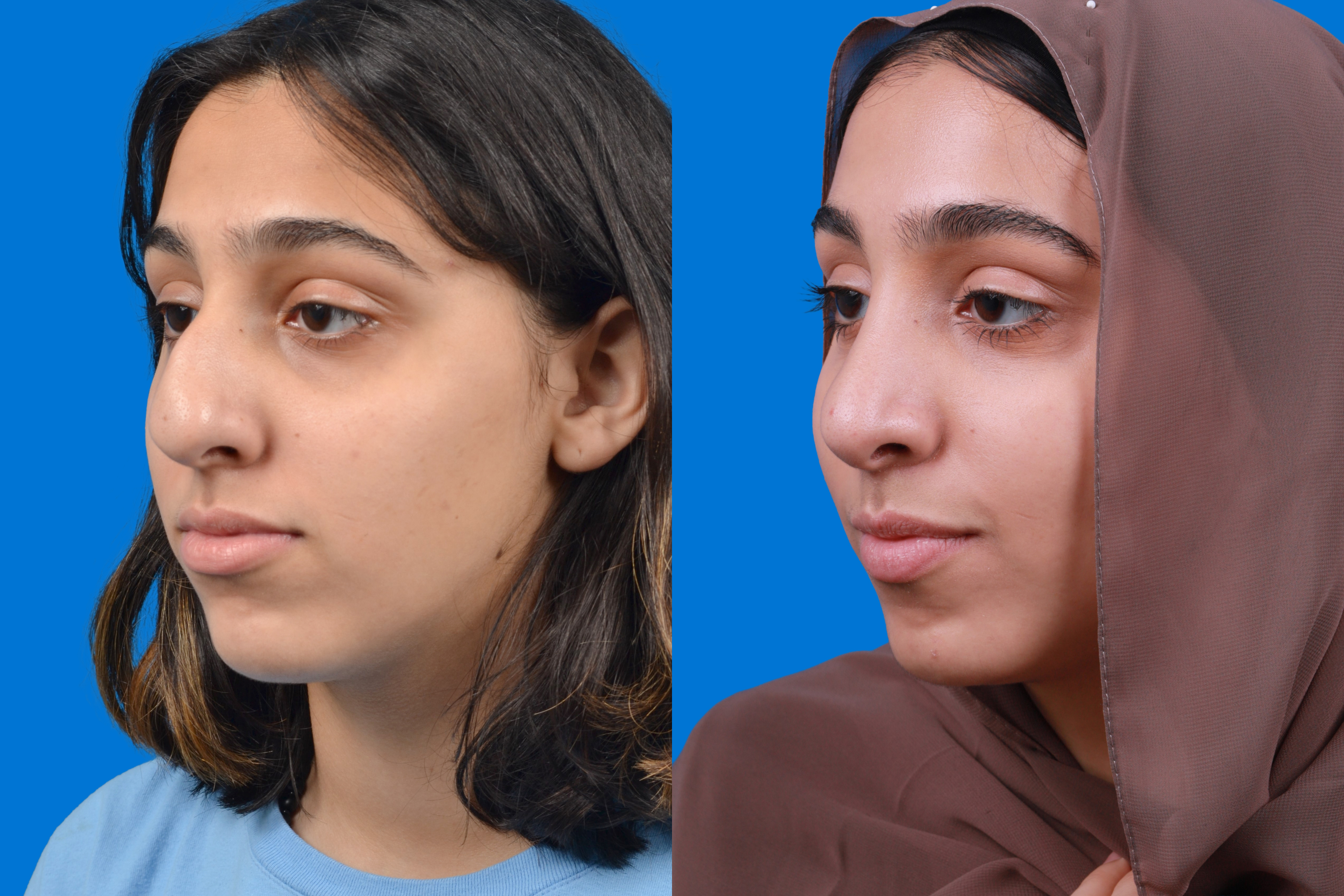 Rhinoplasty Before & After Gallery - Patient 122593916 - Image 4