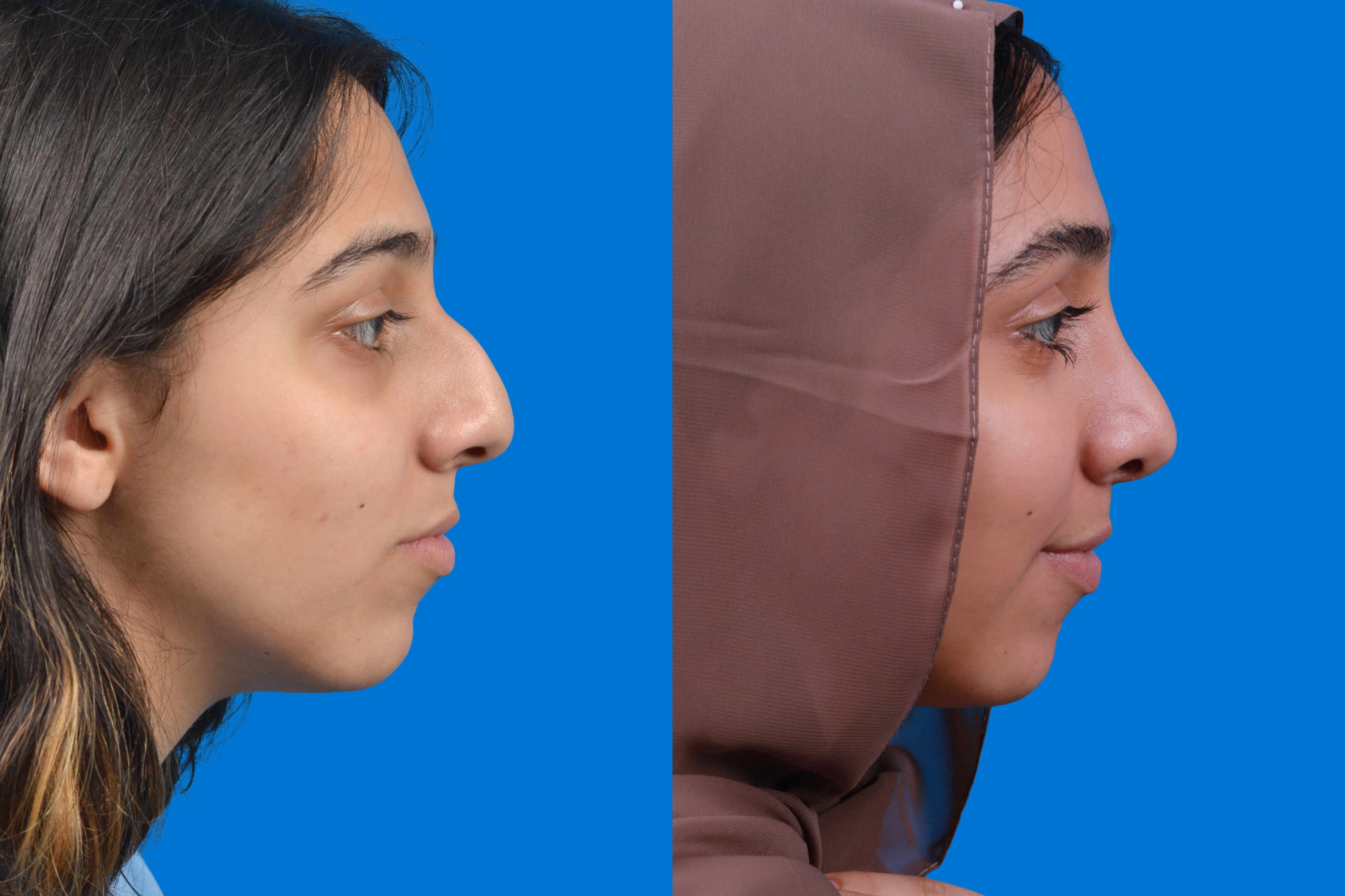 Rhinoplasty Before & After Gallery - Patient 122593916 - Image 1