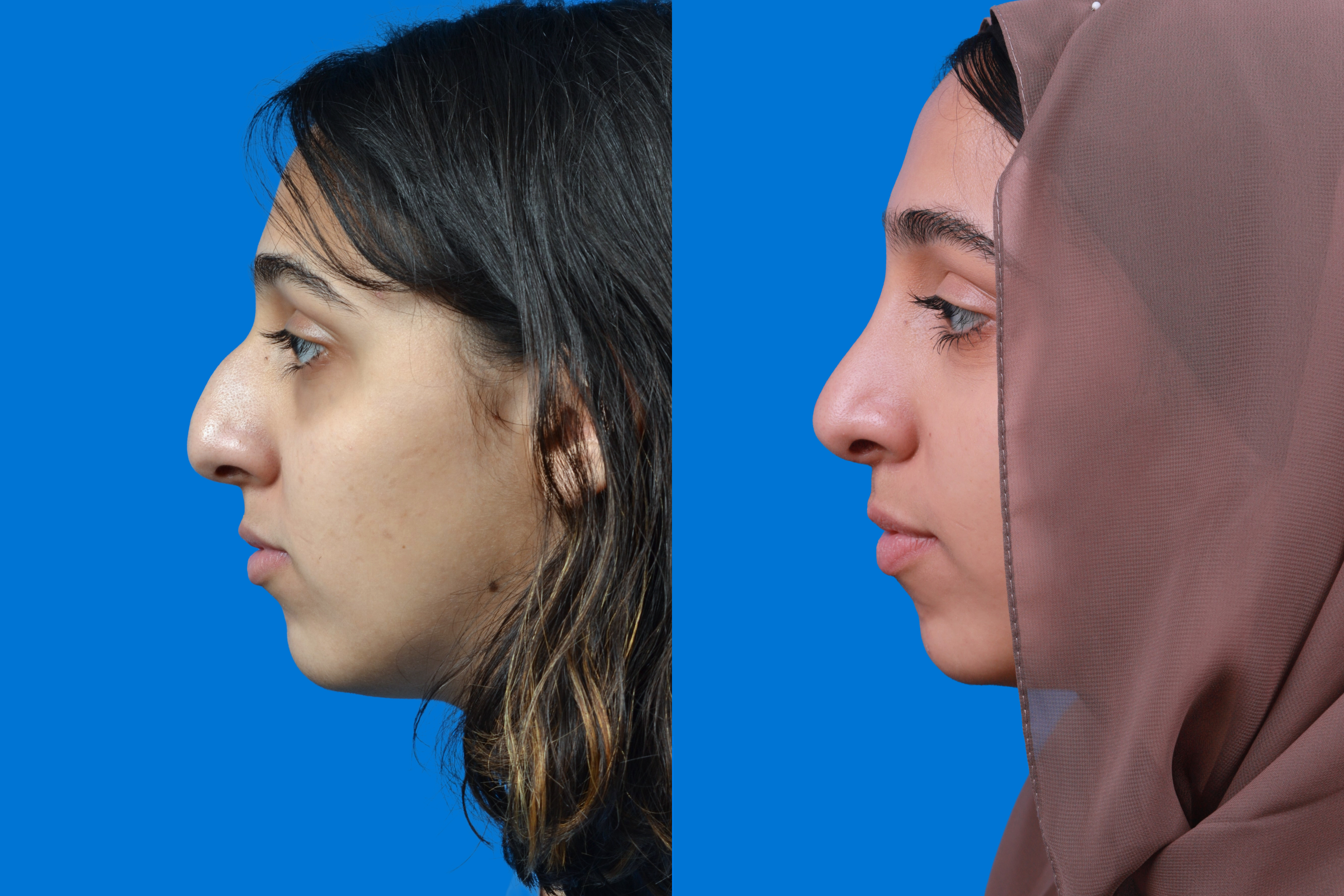 Rhinoplasty Before & After Gallery - Patient 122593916 - Image 5