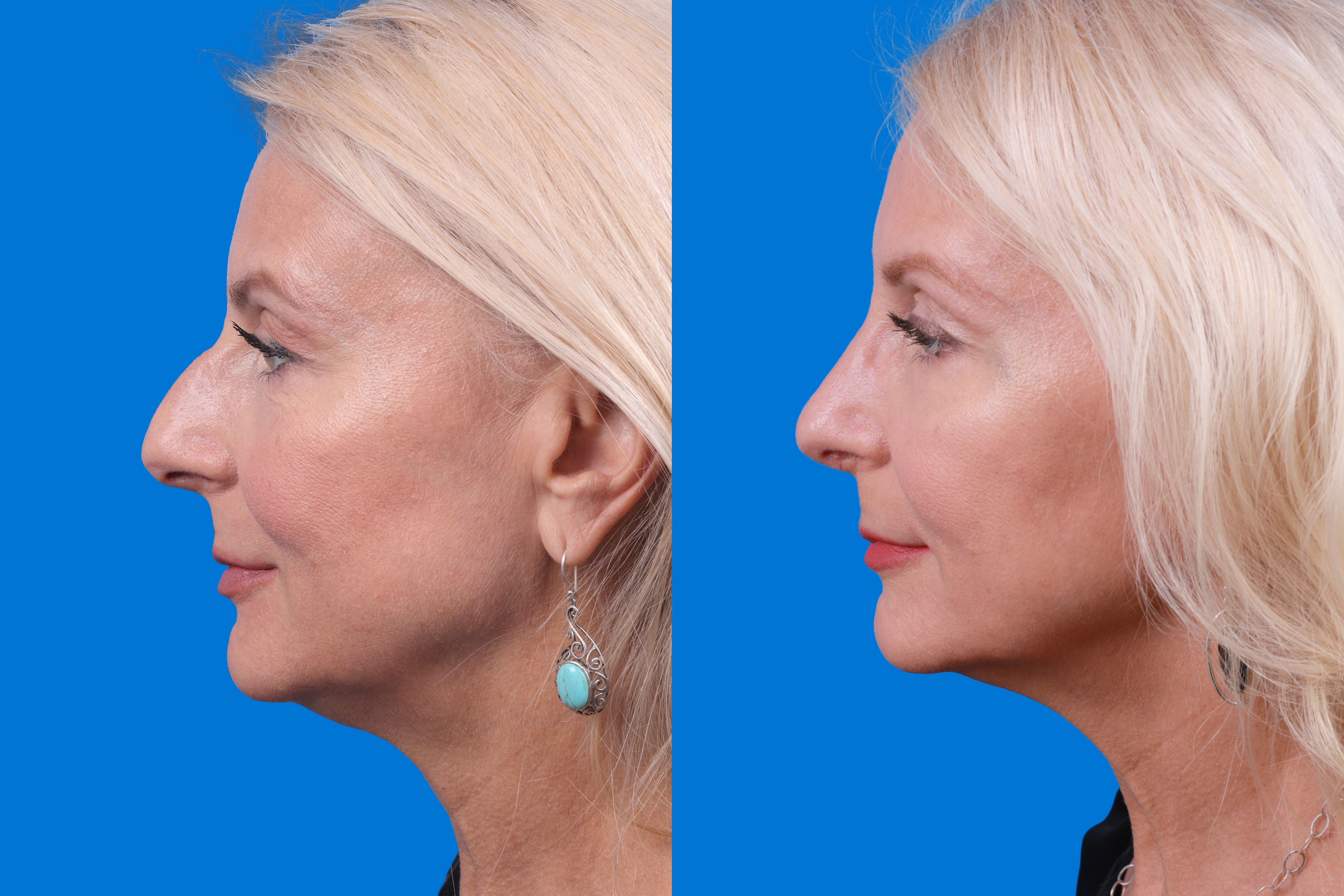 Rhinoplasty Before & After Gallery - Patient 122406987 - Image 1