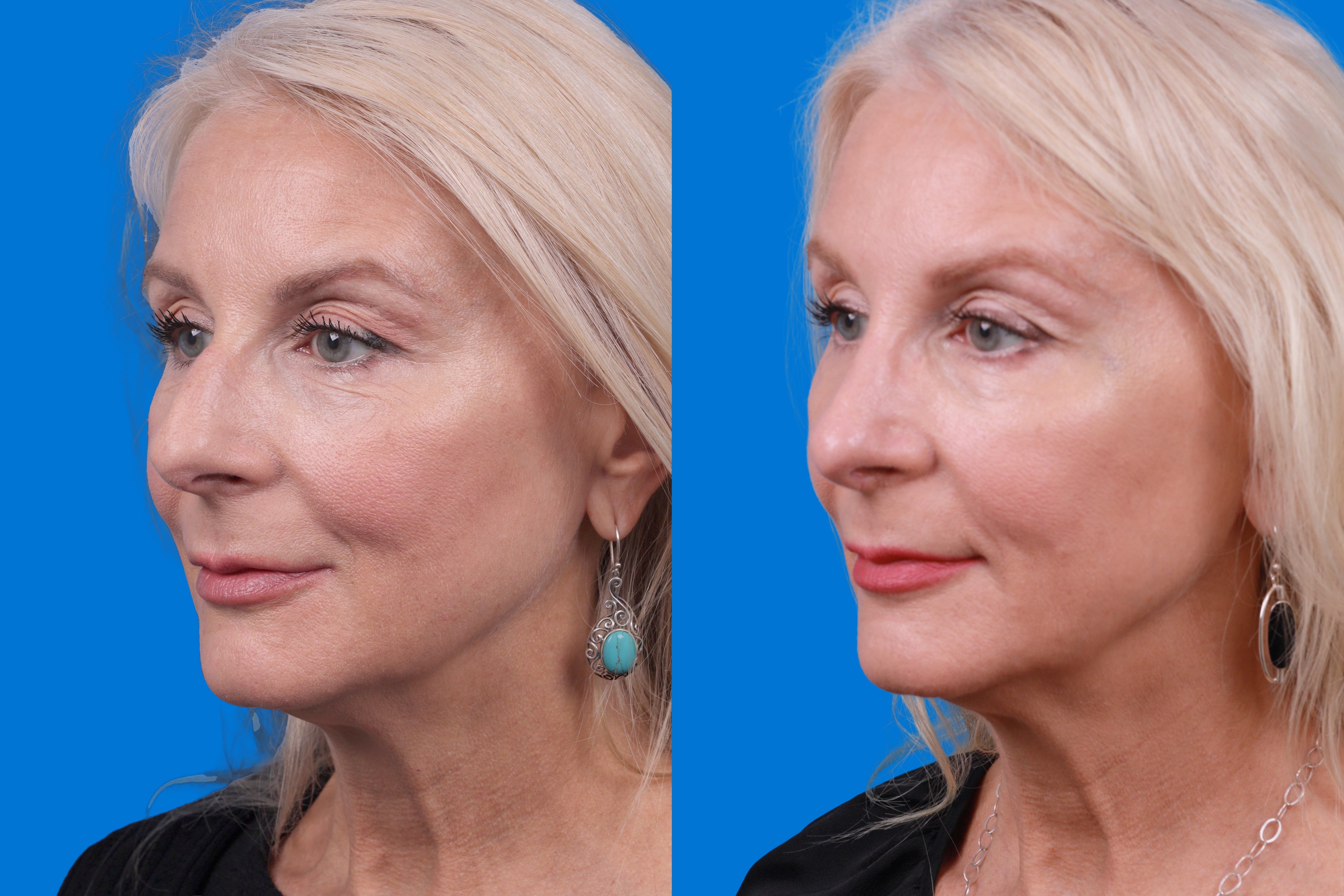 Rhinoplasty Before & After Gallery - Patient 122406987 - Image 2