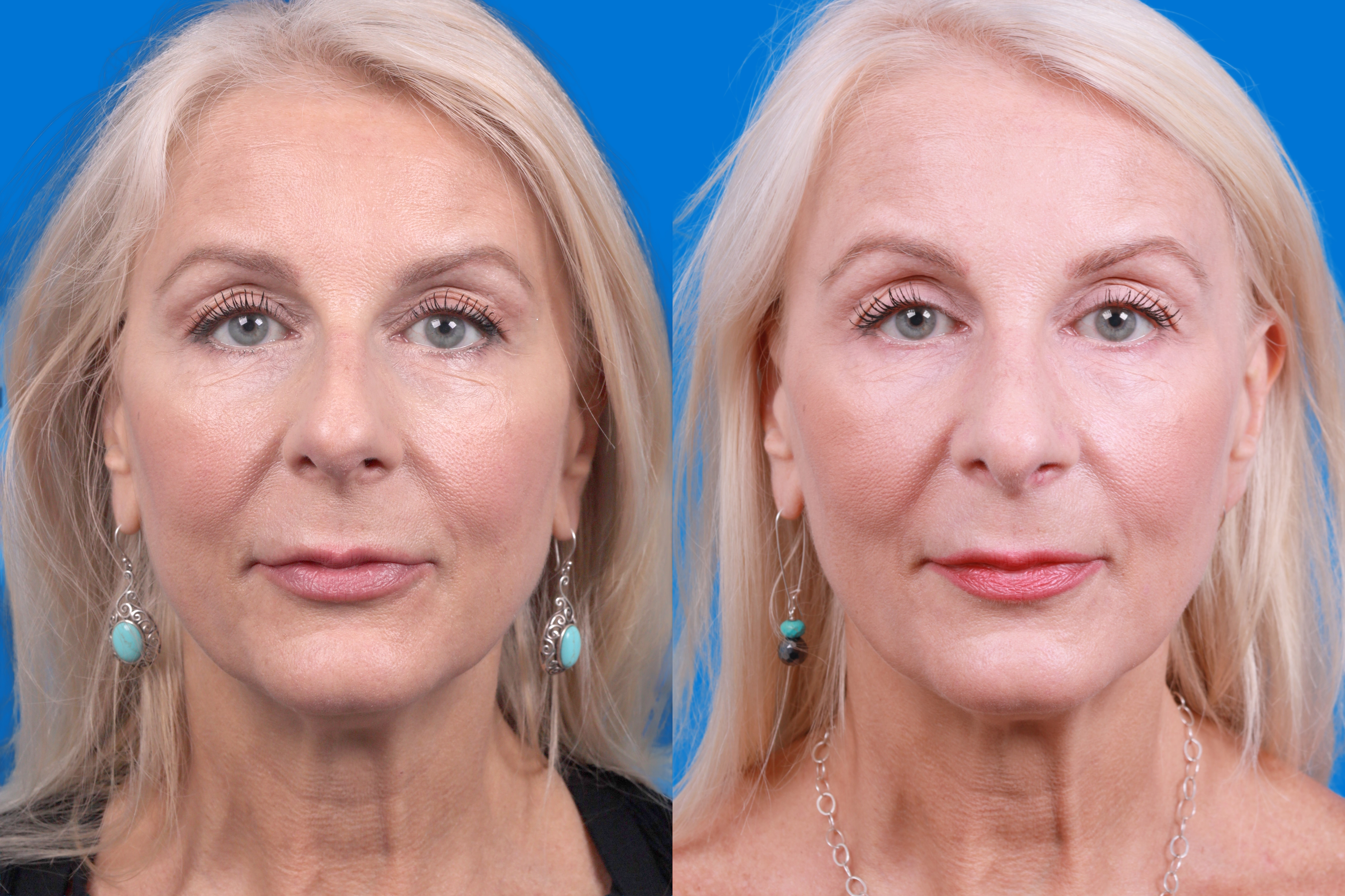 Rhinoplasty Before & After Gallery - Patient 122406987 - Image 3