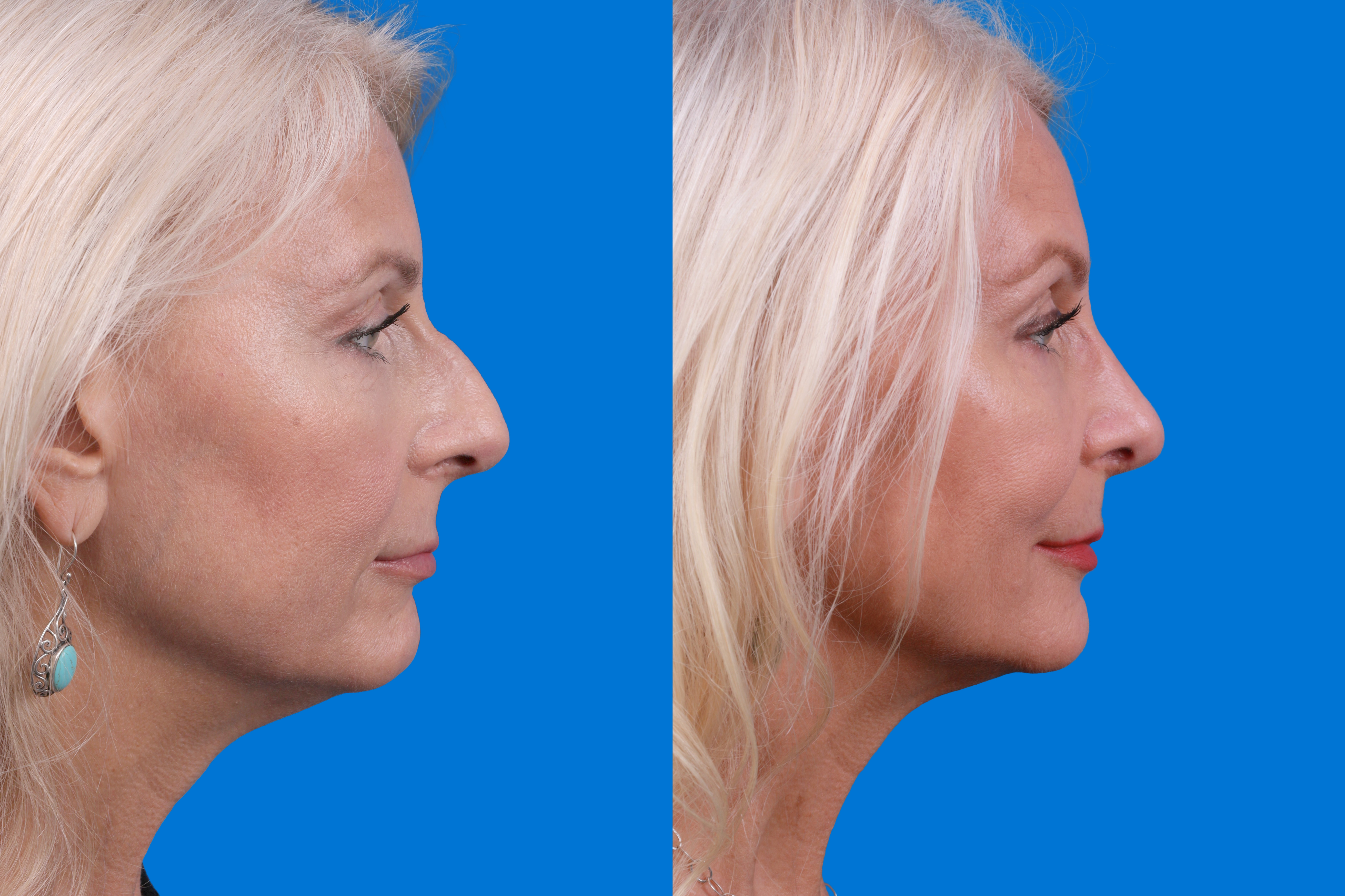 Rhinoplasty Before & After Gallery - Patient 122406987 - Image 5