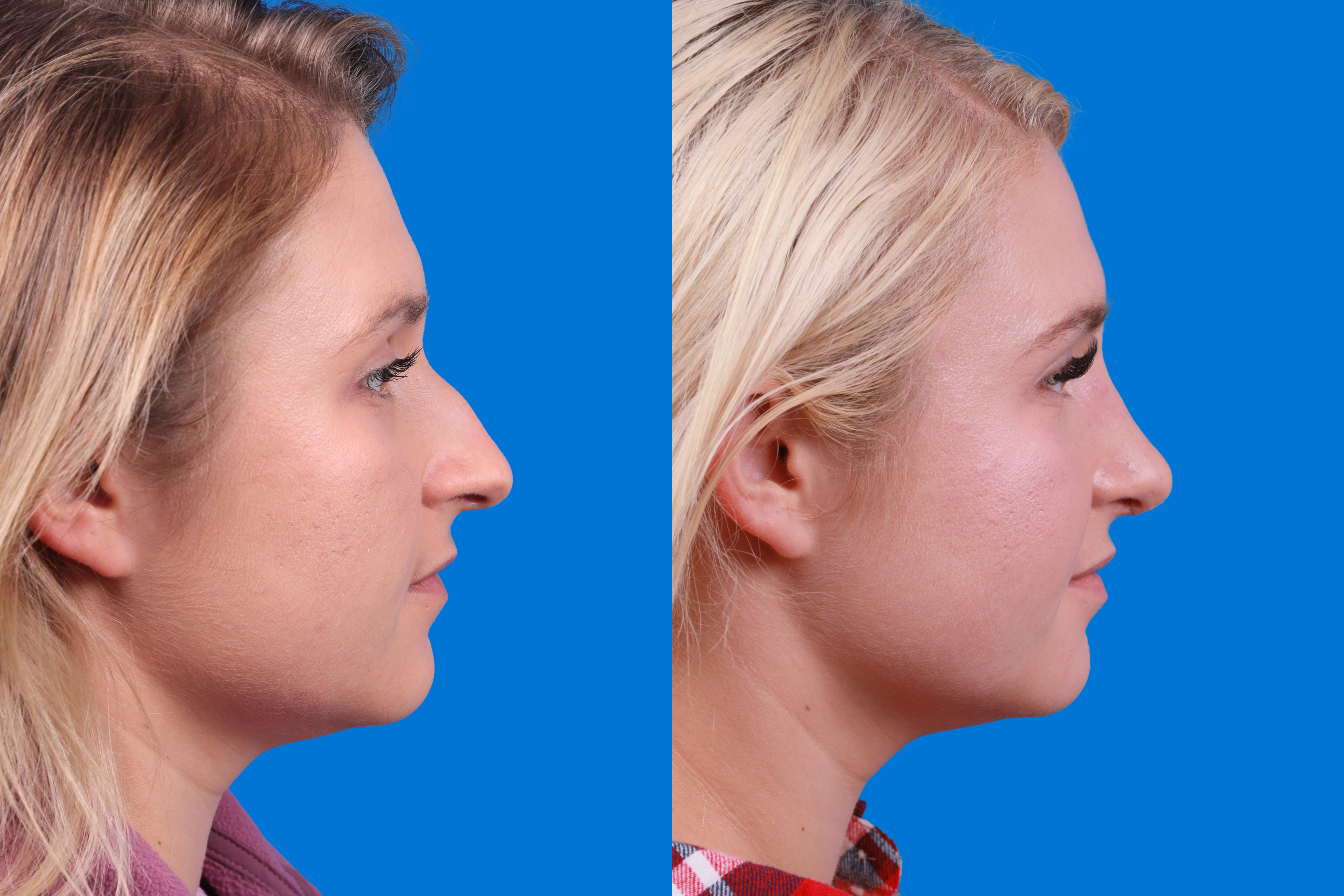 Rhinoplasty Before & After Gallery - Patient 122406981 - Image 3