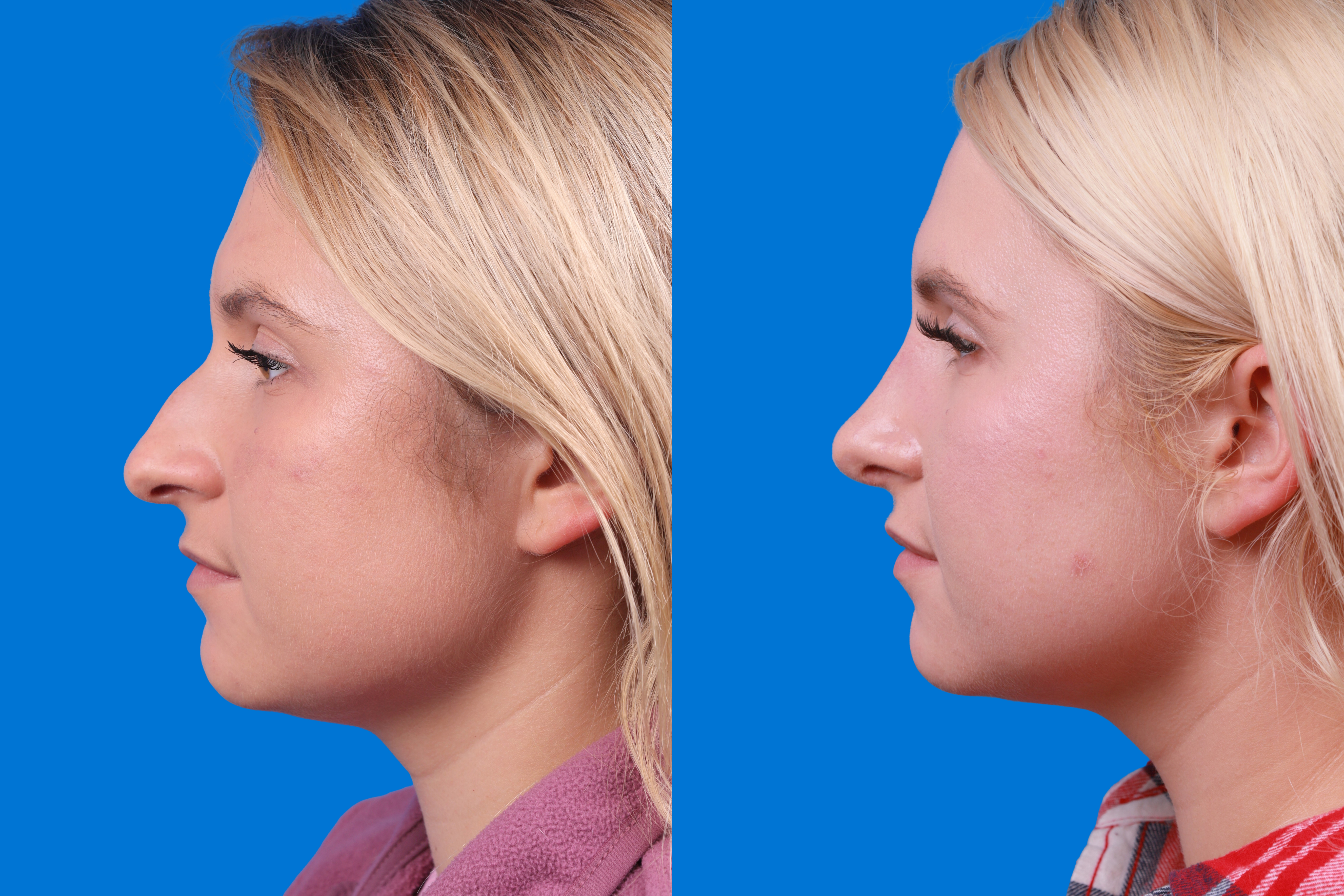 Rhinoplasty Before & After Gallery - Patient 122406981 - Image 5