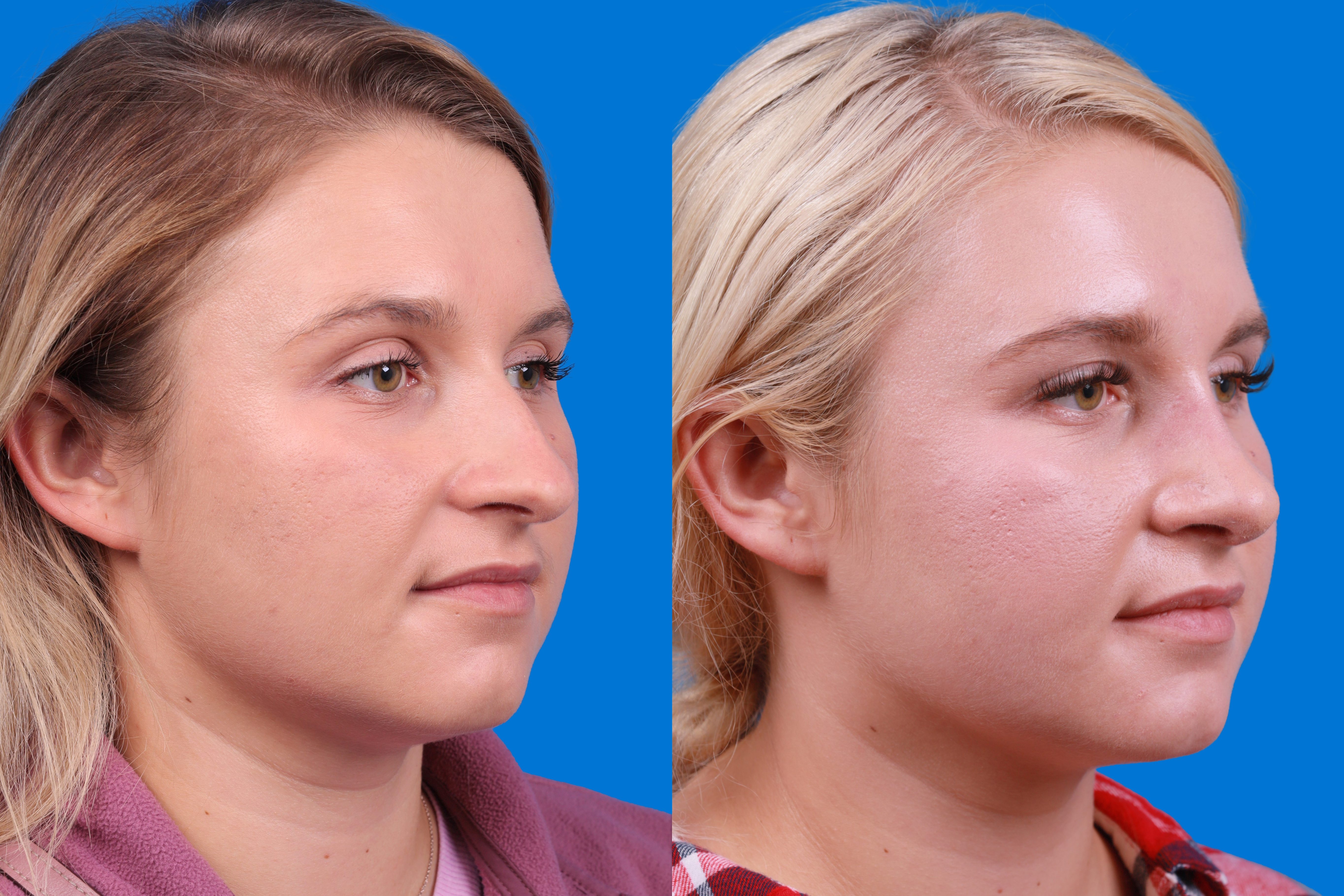 Rhinoplasty Before & After Gallery - Patient 122406981 - Image 2
