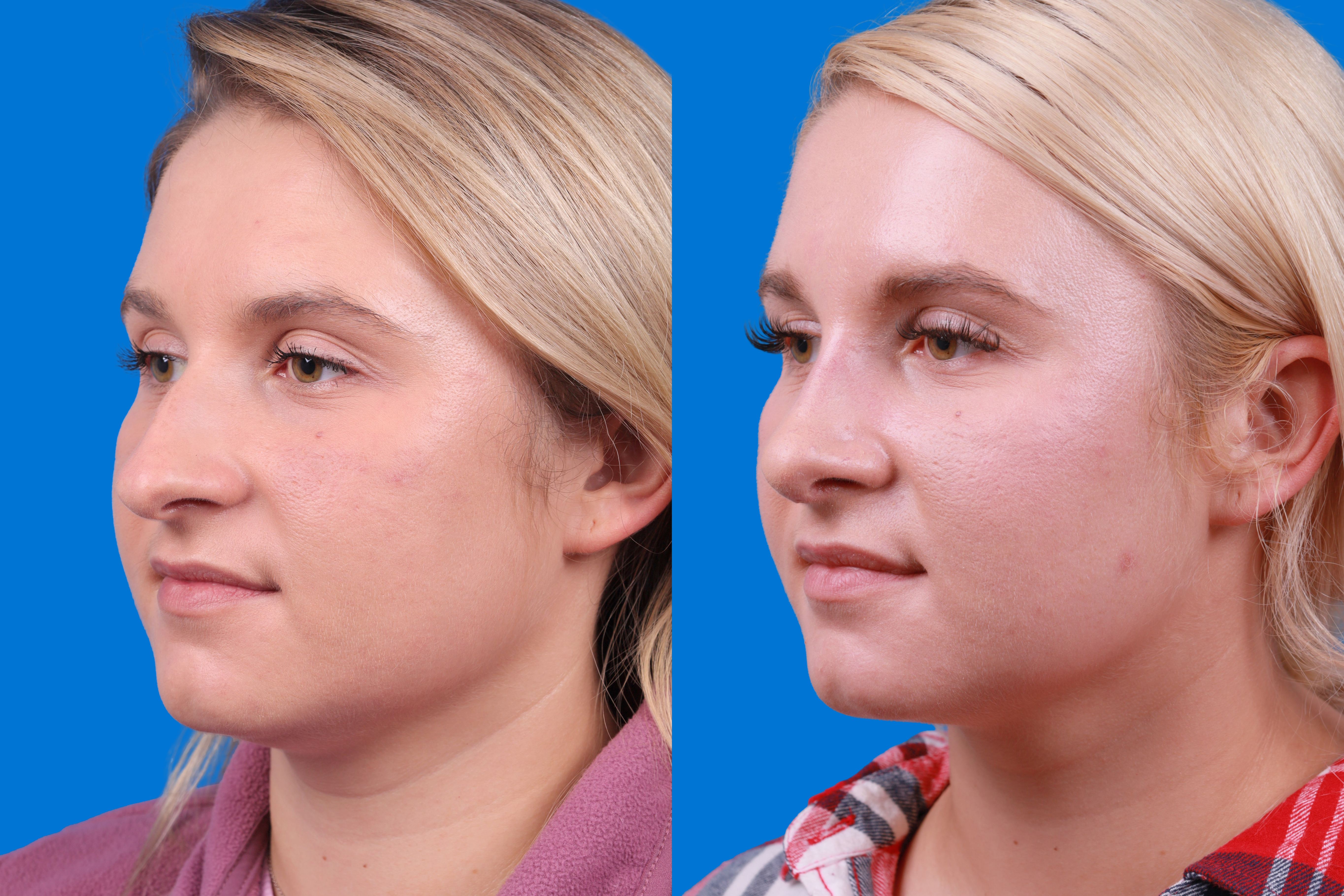 Rhinoplasty Before & After Gallery - Patient 122406981 - Image 4