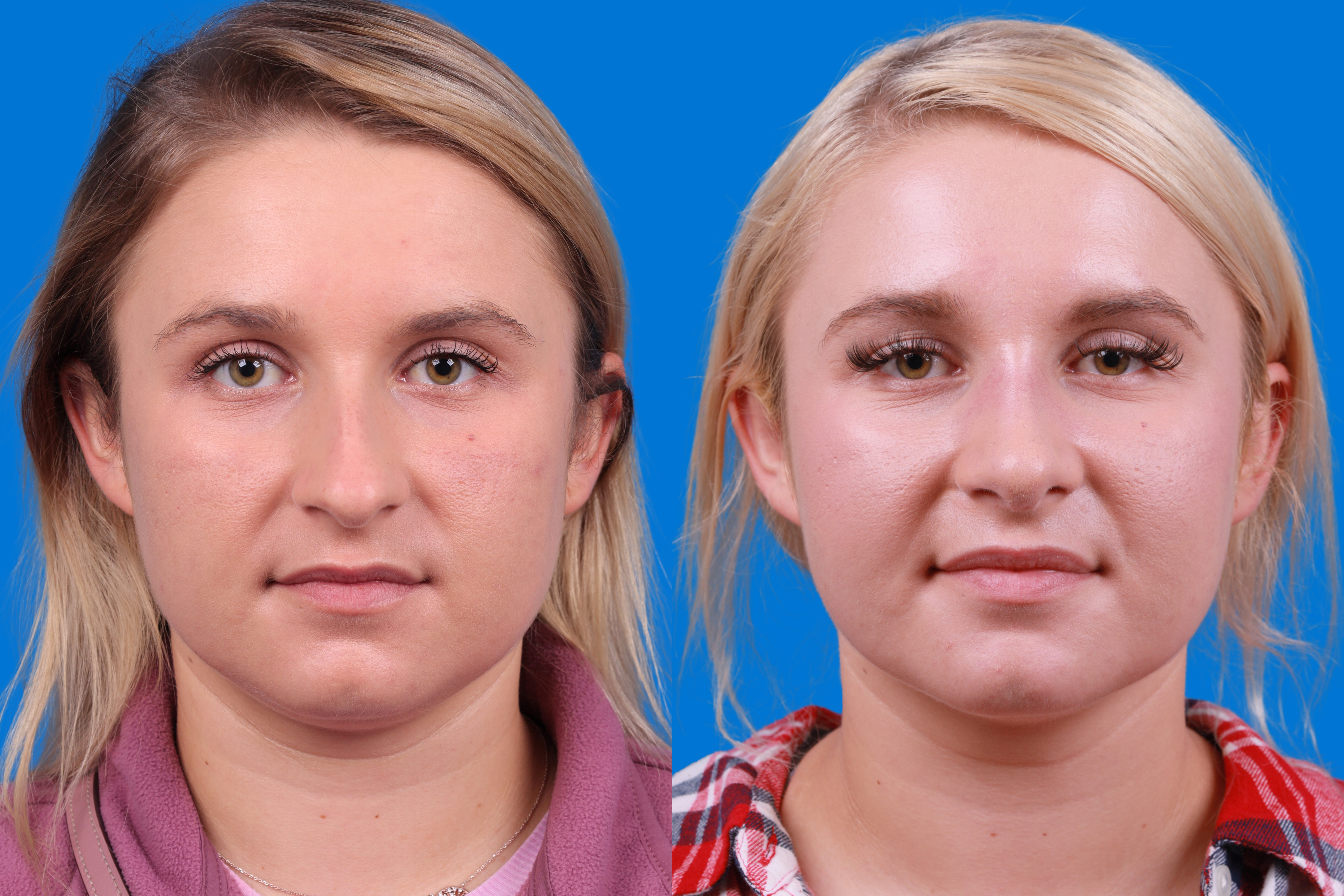 Rhinoplasty Before & After Gallery - Patient 122406981 - Image 1