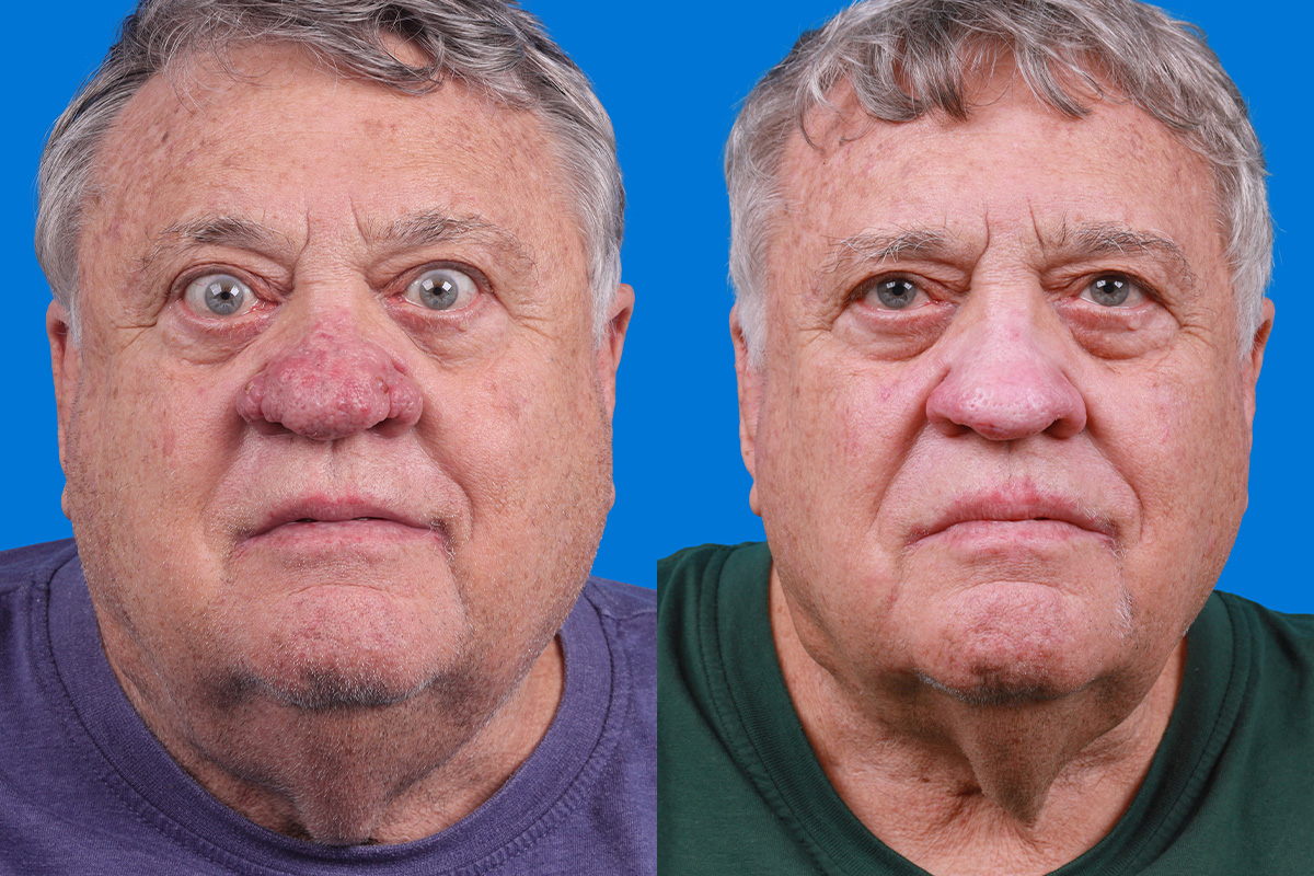 Rhinophyma Before & After Gallery - Patient 184320148 - Image 1