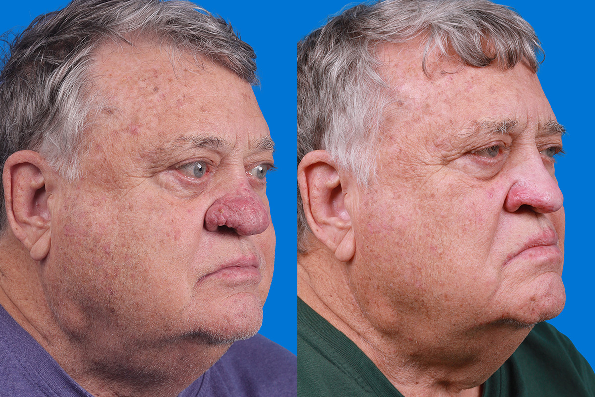 Rhinophyma Before & After Gallery - Patient 184320148 - Image 2