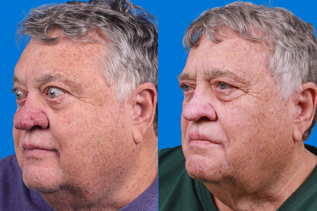 Rhinophyma Before & After Gallery - Patient 184320148 - Image 4