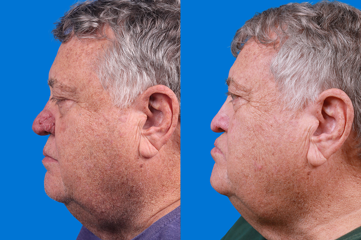 Rhinophyma Before & After Gallery - Patient 184320148 - Image 5
