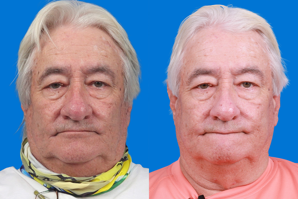 Rhinophyma Before & After Gallery - Patient 327213 - Image 1