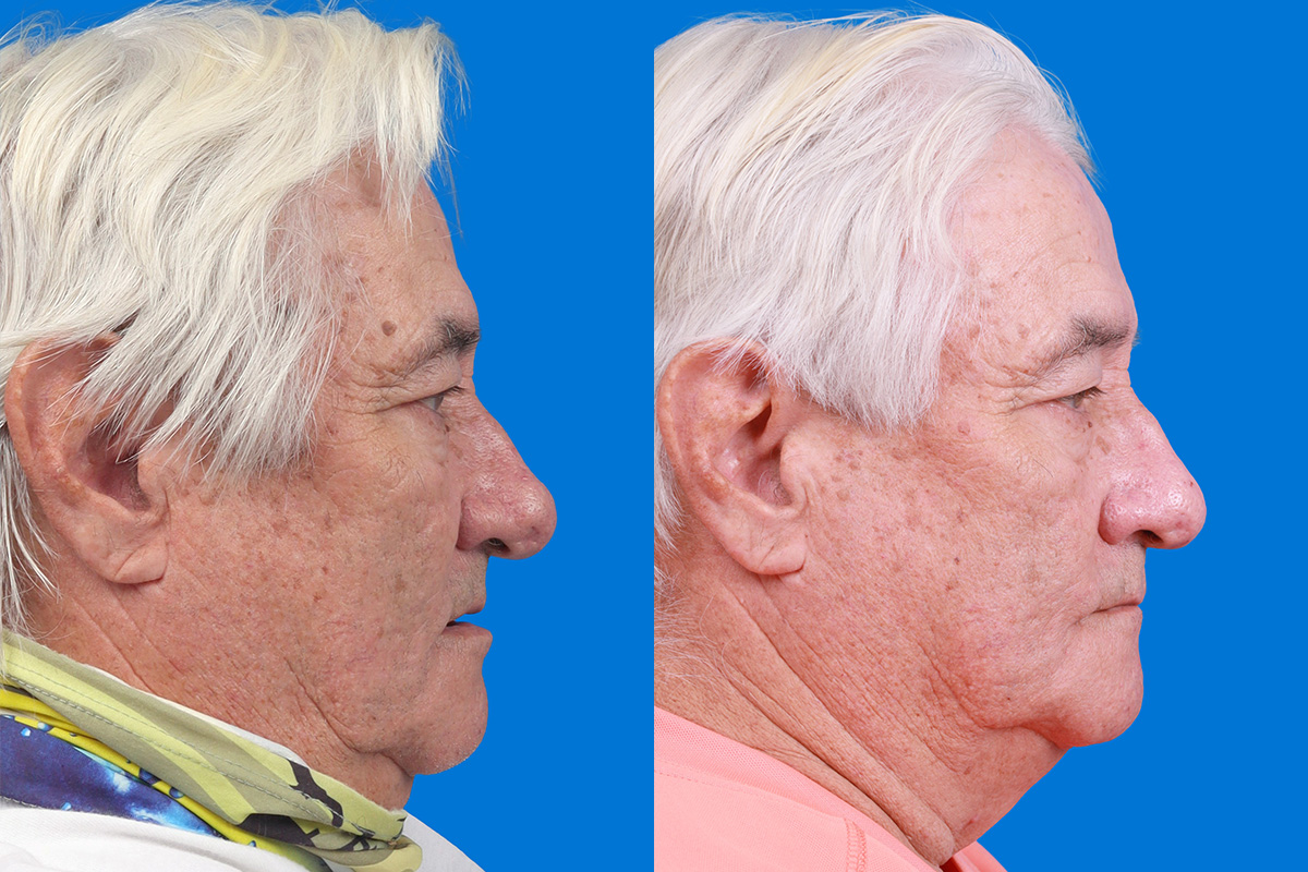 Rhinophyma Before & After Gallery - Patient 327213 - Image 3