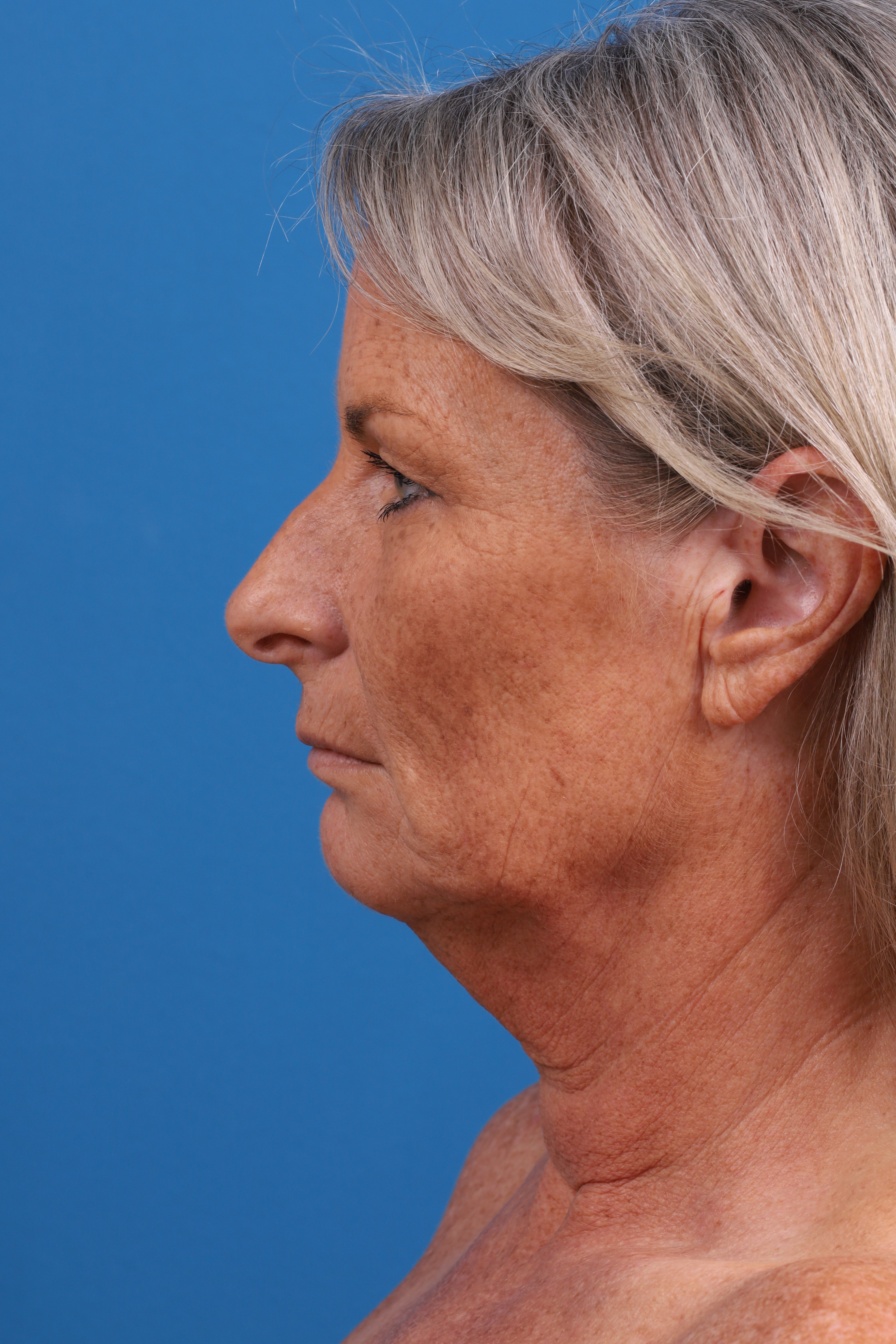 Eyelid Surgery Before & After Gallery - Patient 419045 - Image 7