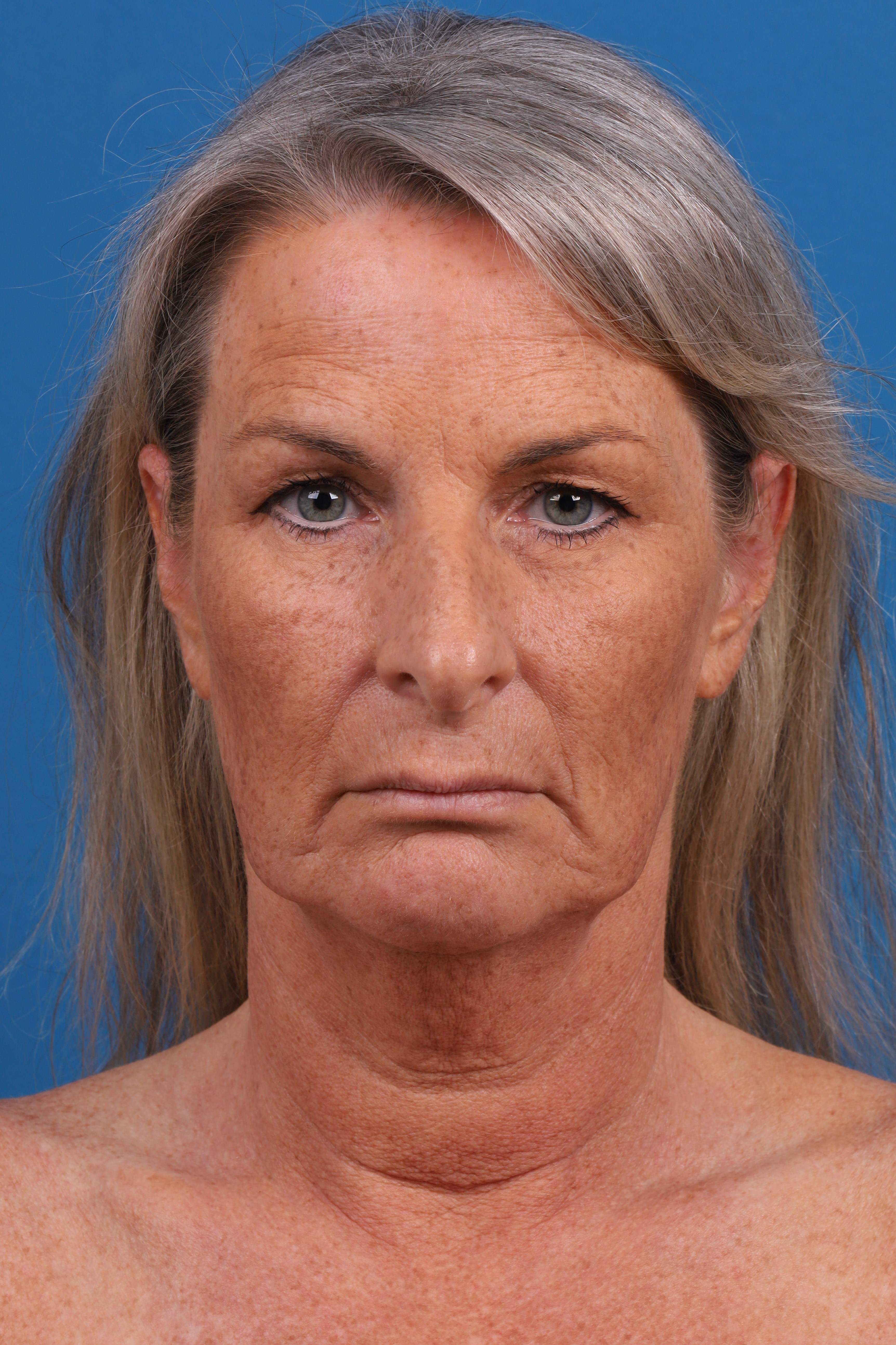 Eyelid Surgery Before & After Gallery - Patient 419045 - Image 1