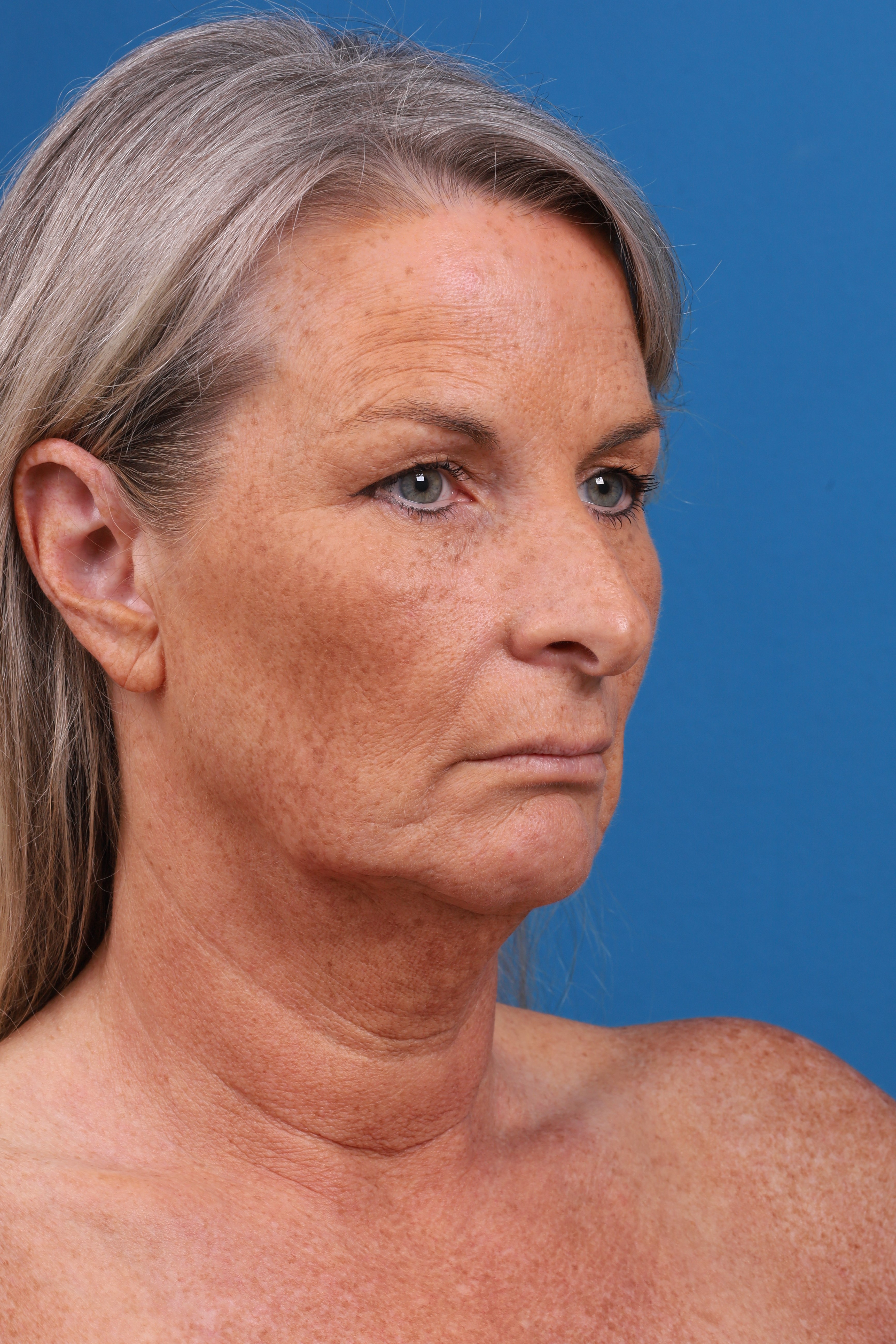 Eyelid Surgery Before & After Gallery - Patient 419045 - Image 5