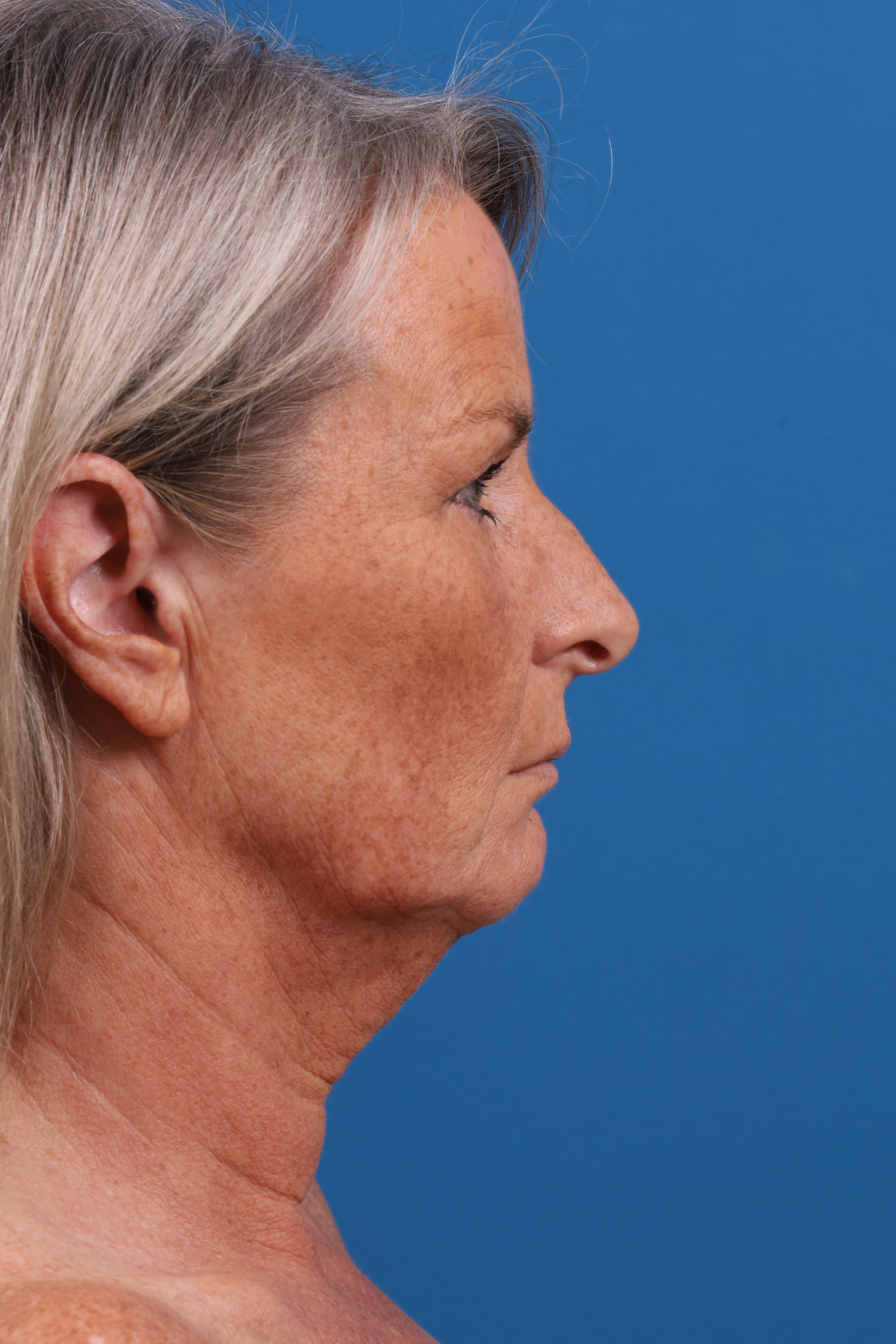 Facelift Before & After Gallery - Patient 231582 - Image 1
