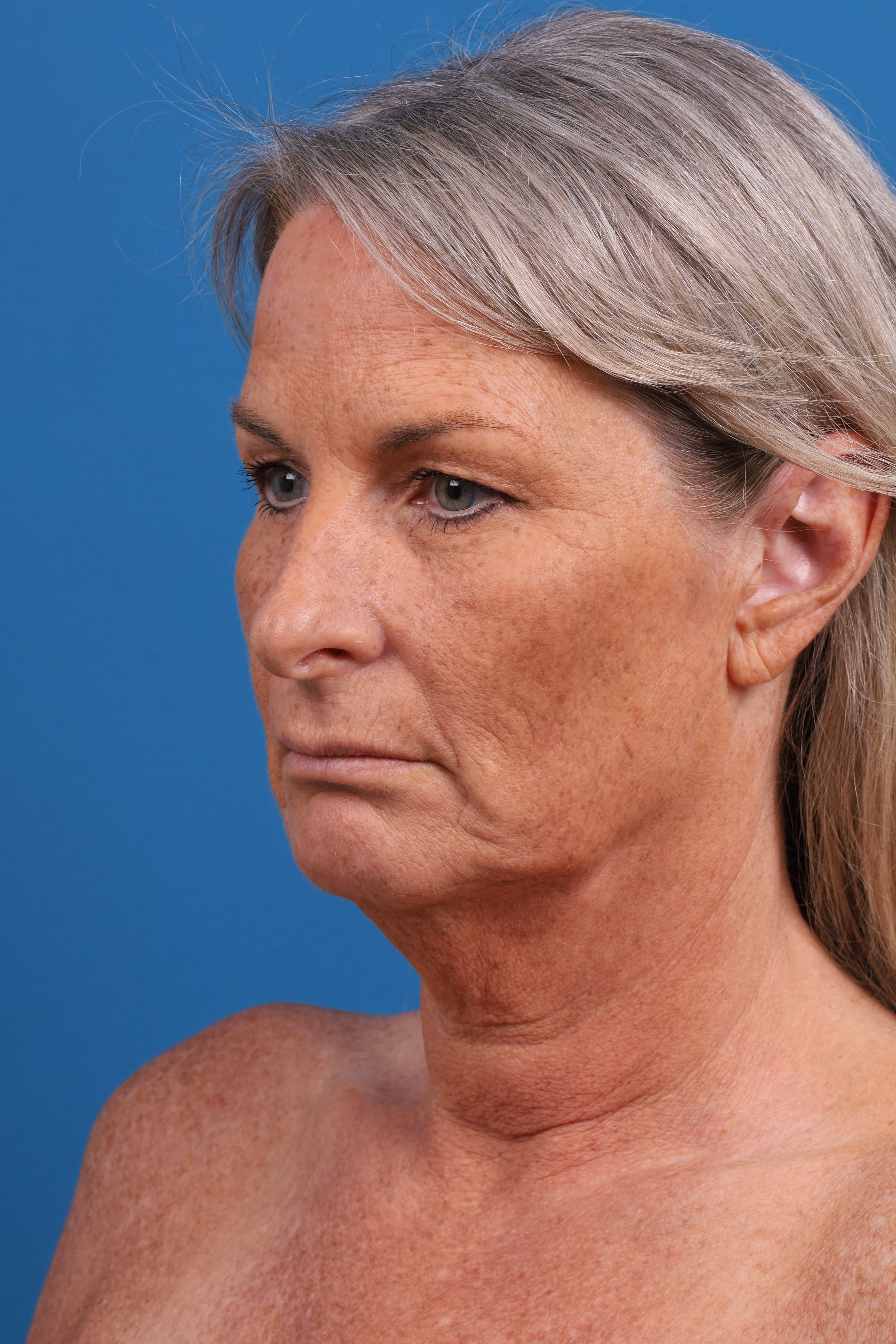 Eyelid Surgery Before & After Gallery - Patient 419045 - Image 3