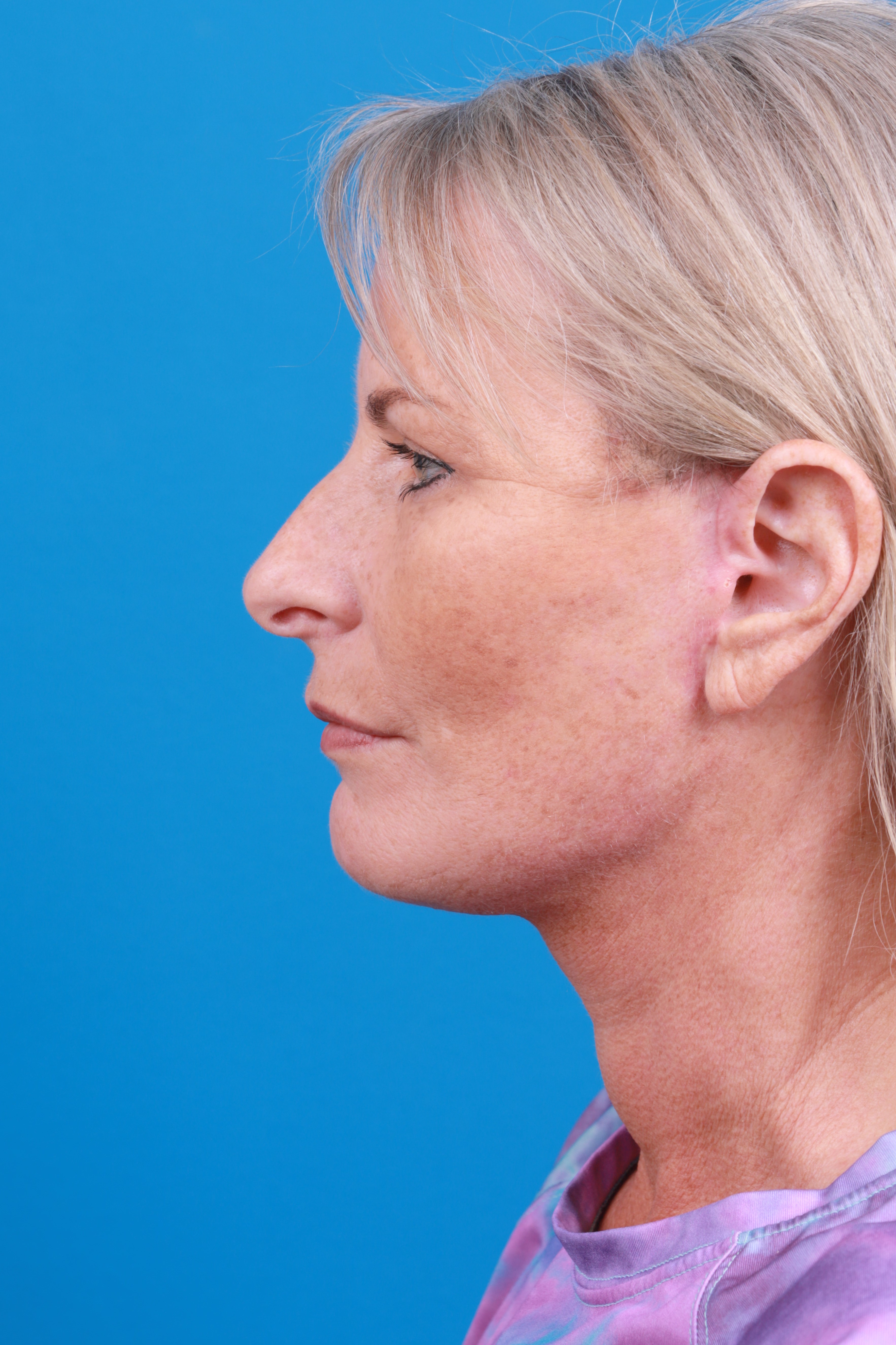 Eyelid Surgery Before & After Gallery - Patient 419045 - Image 8