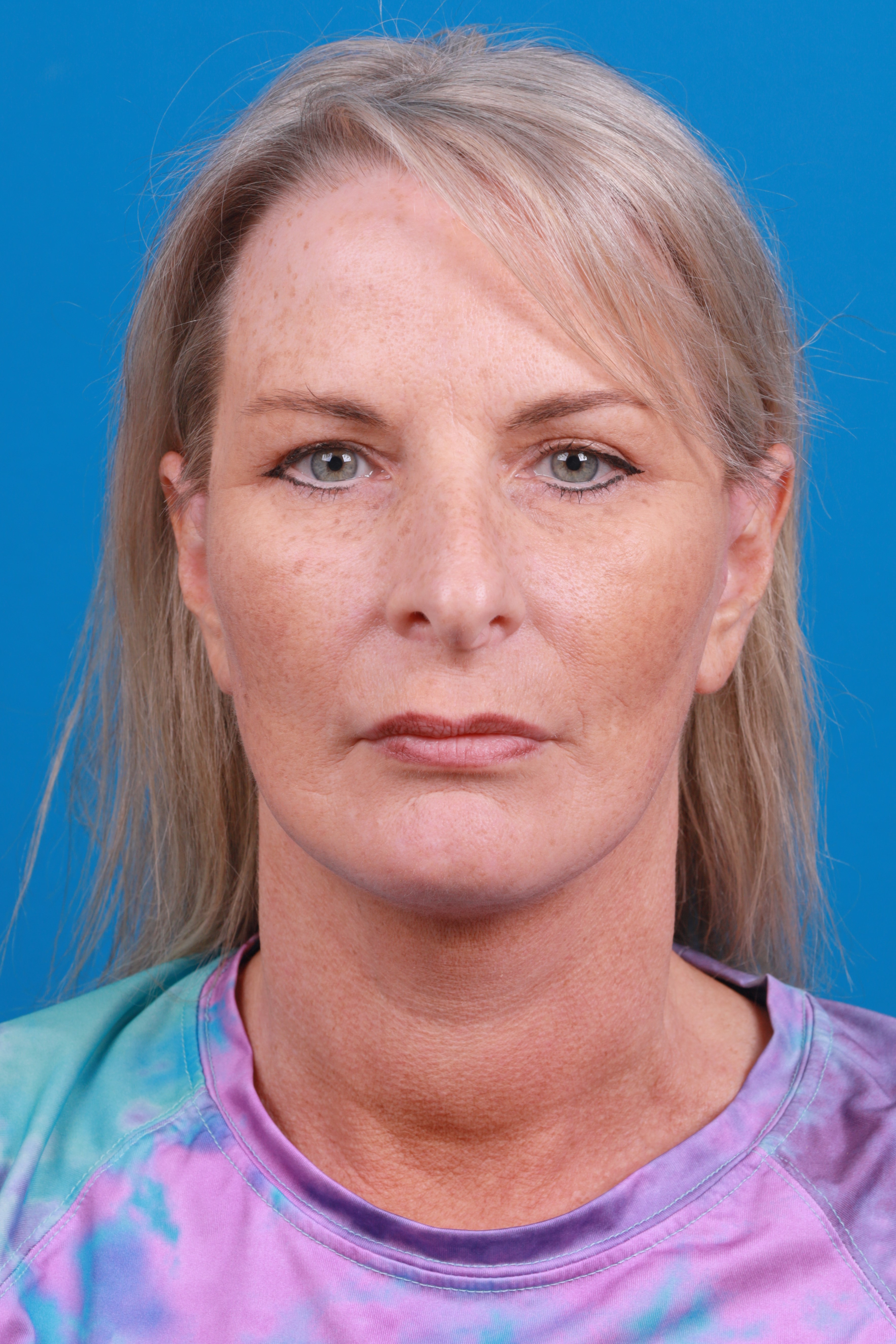 Eyelid Surgery Before & After Gallery - Patient 419045 - Image 2