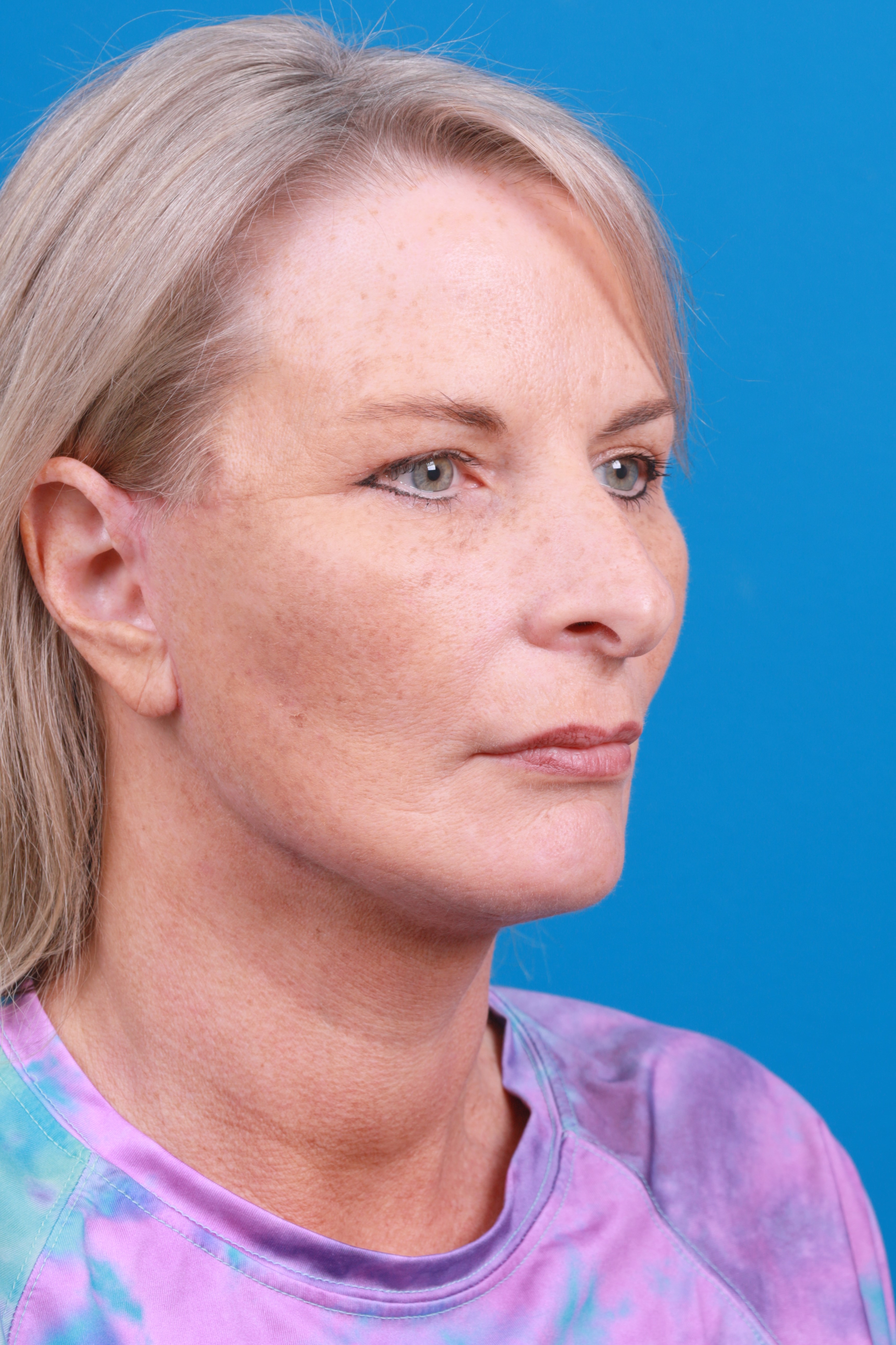Eyelid Surgery Before & After Gallery - Patient 419045 - Image 6