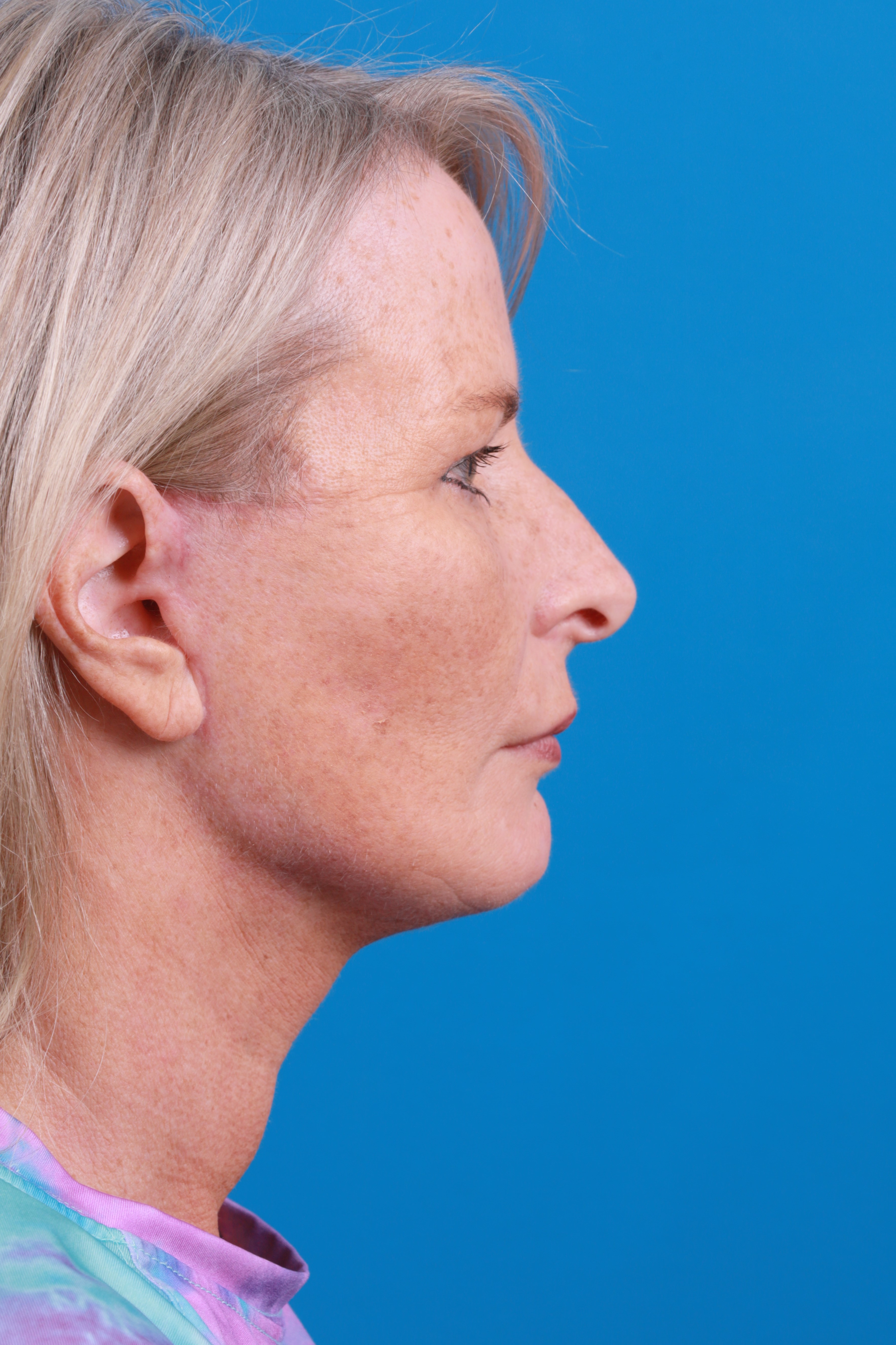 Facelift Before & After Gallery - Patient 231582 - Image 2
