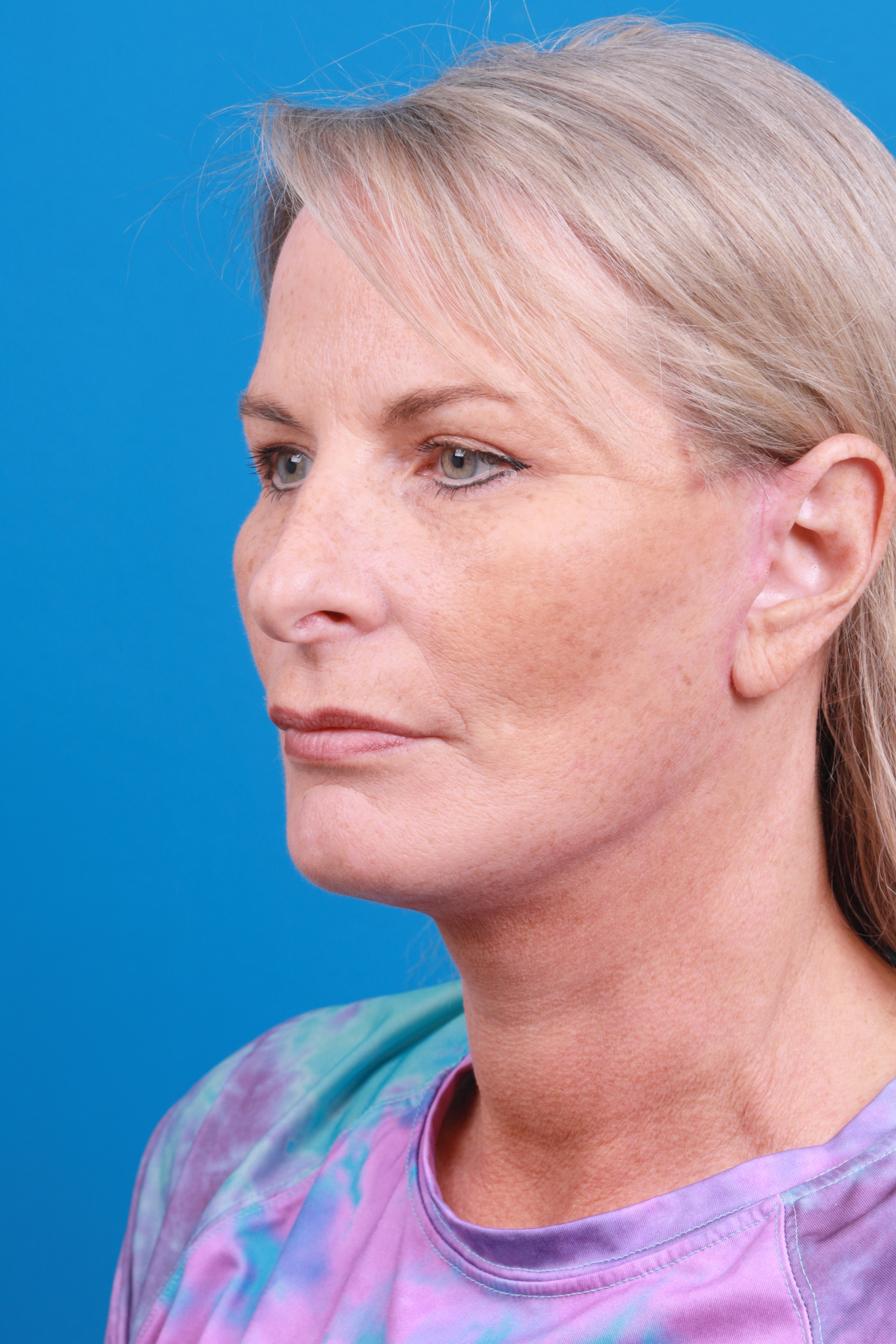 Eyelid Surgery Before & After Gallery - Patient 419045 - Image 4