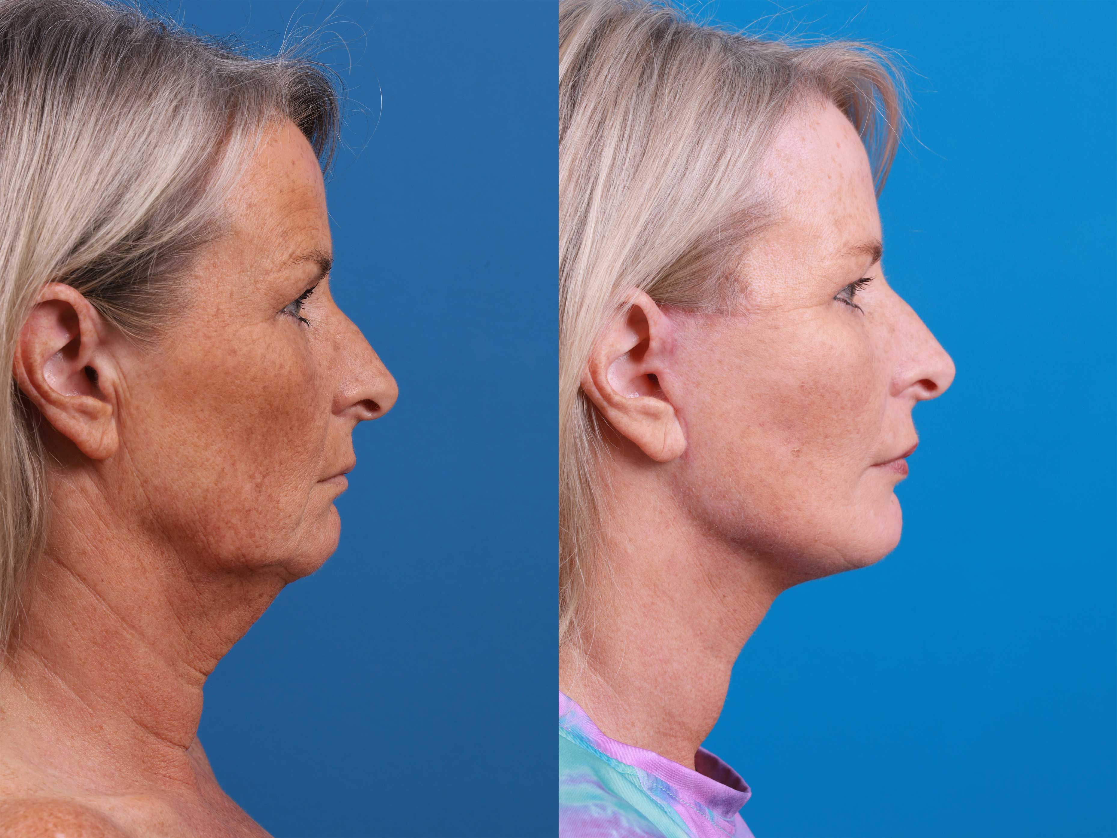 Facelift Before & After Gallery - Patient 231582 - Image 1