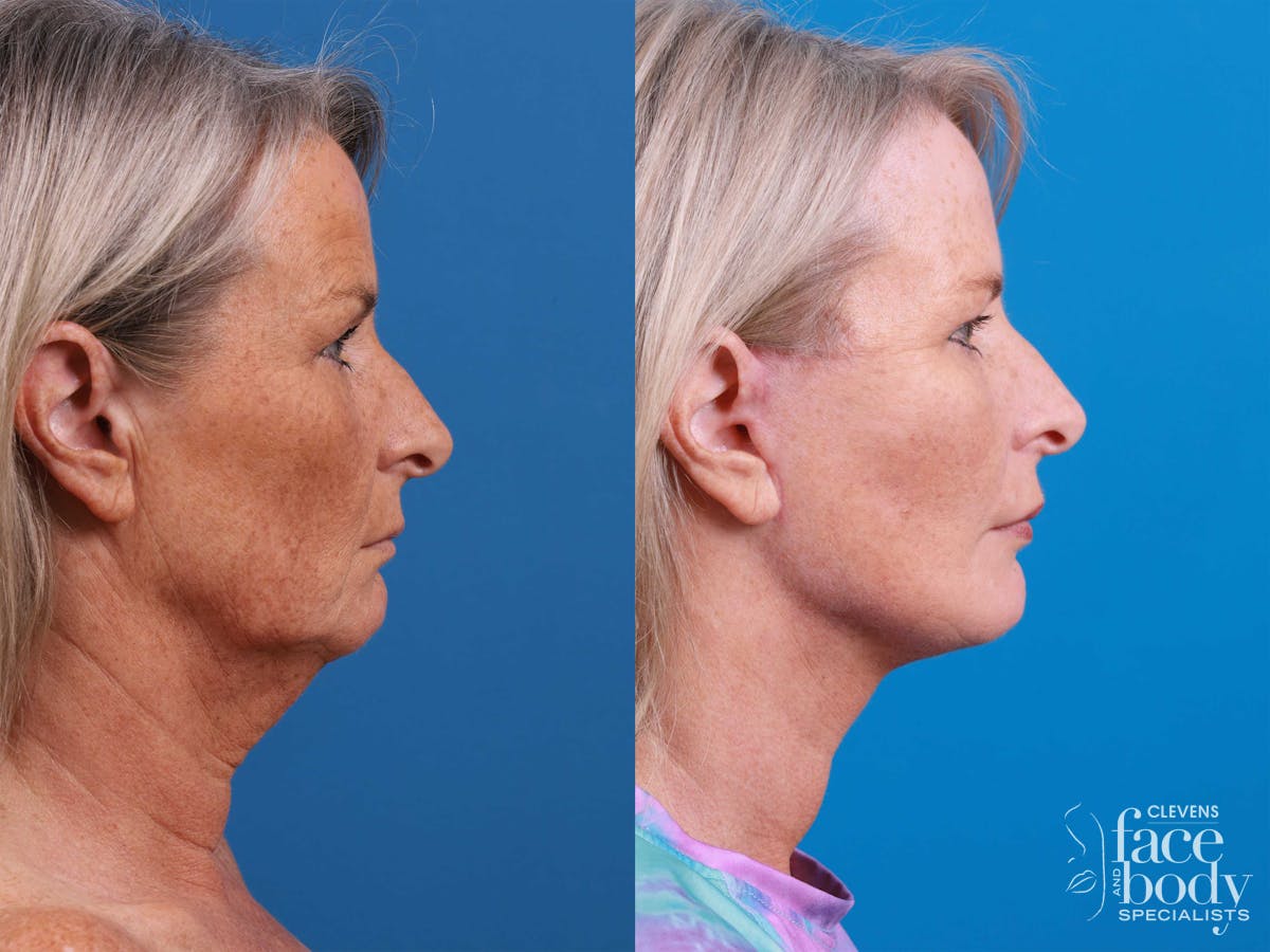 Eyelid Surgery Before & After Gallery - Patient 419045 - Image 3