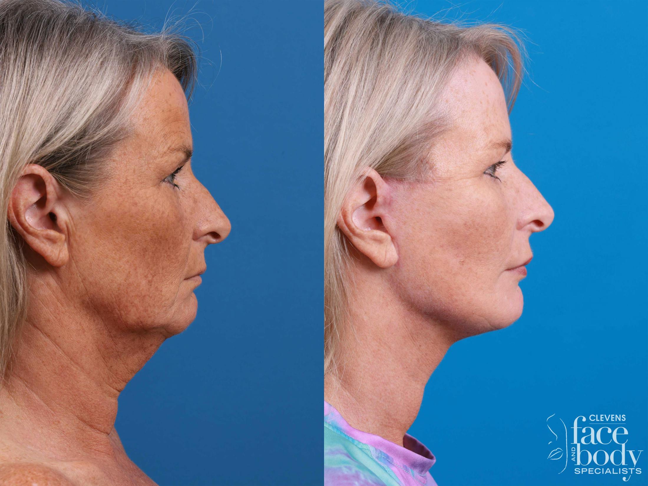 Eyelid Surgery Before & After Gallery - Patient 419045 - Image 3