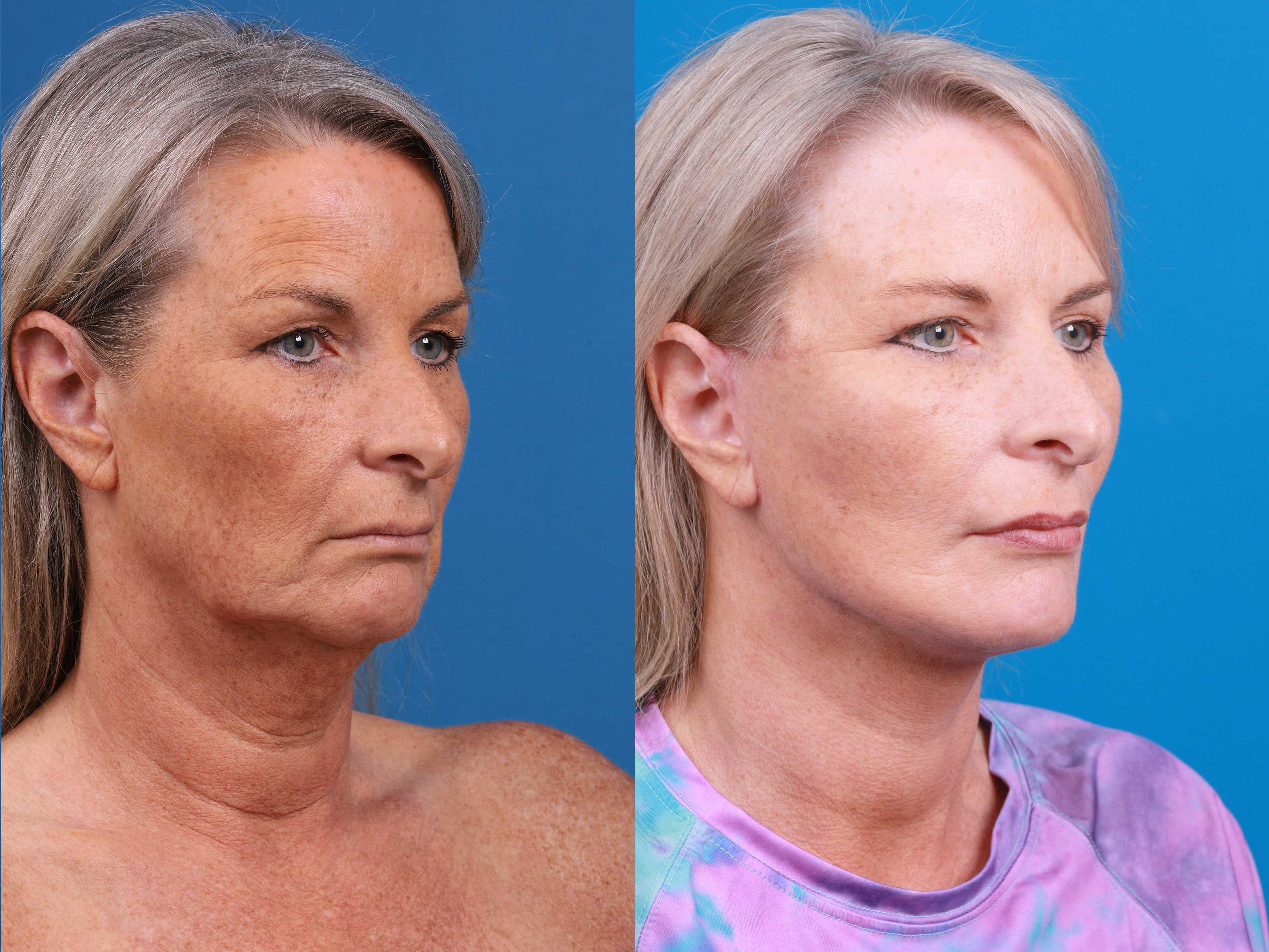 Eyelid Surgery Before & After Gallery - Patient 419045 - Image 2